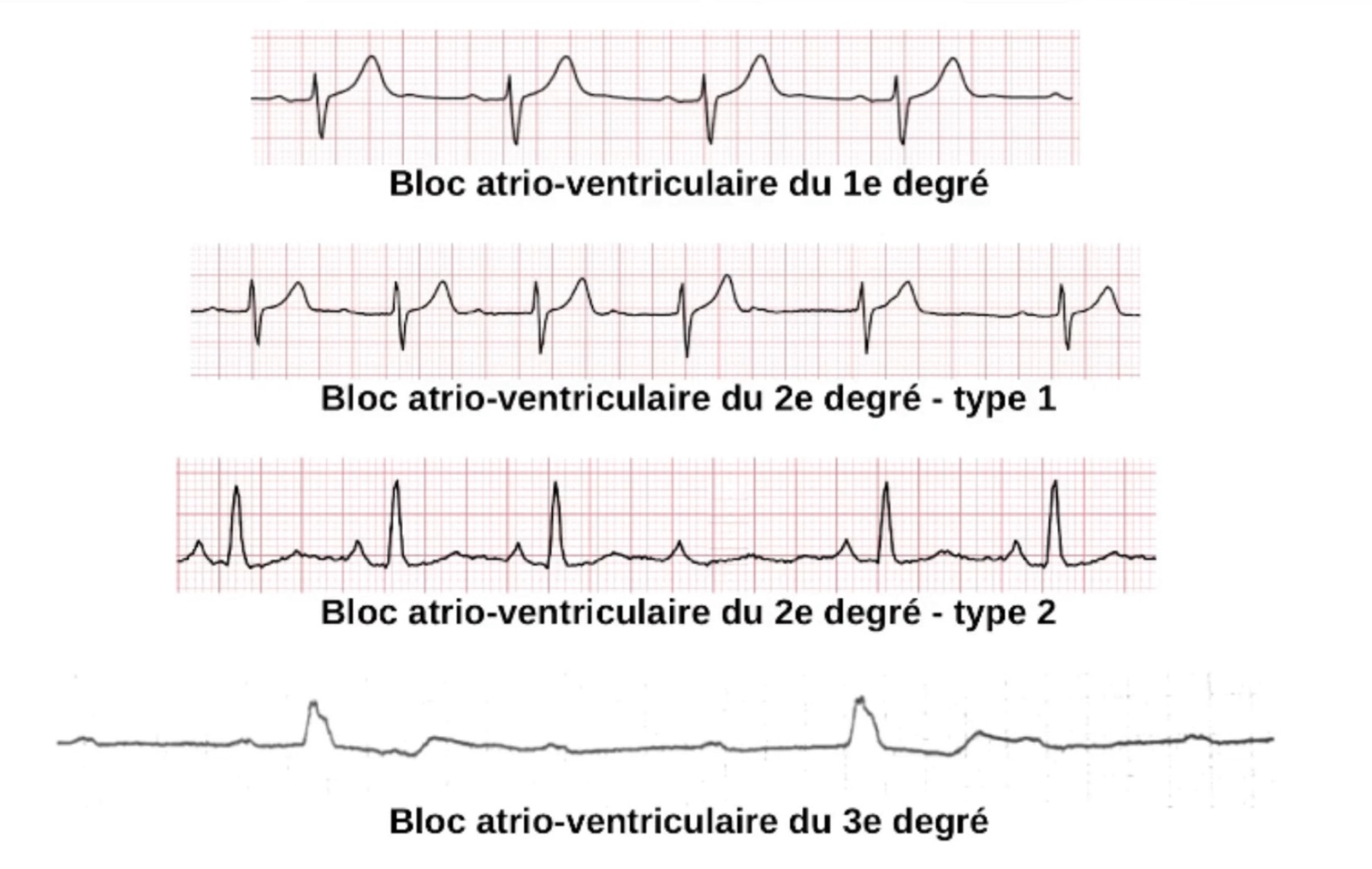 BAV tracings — exemples ECG BAV I, II type 1, II type 2, III