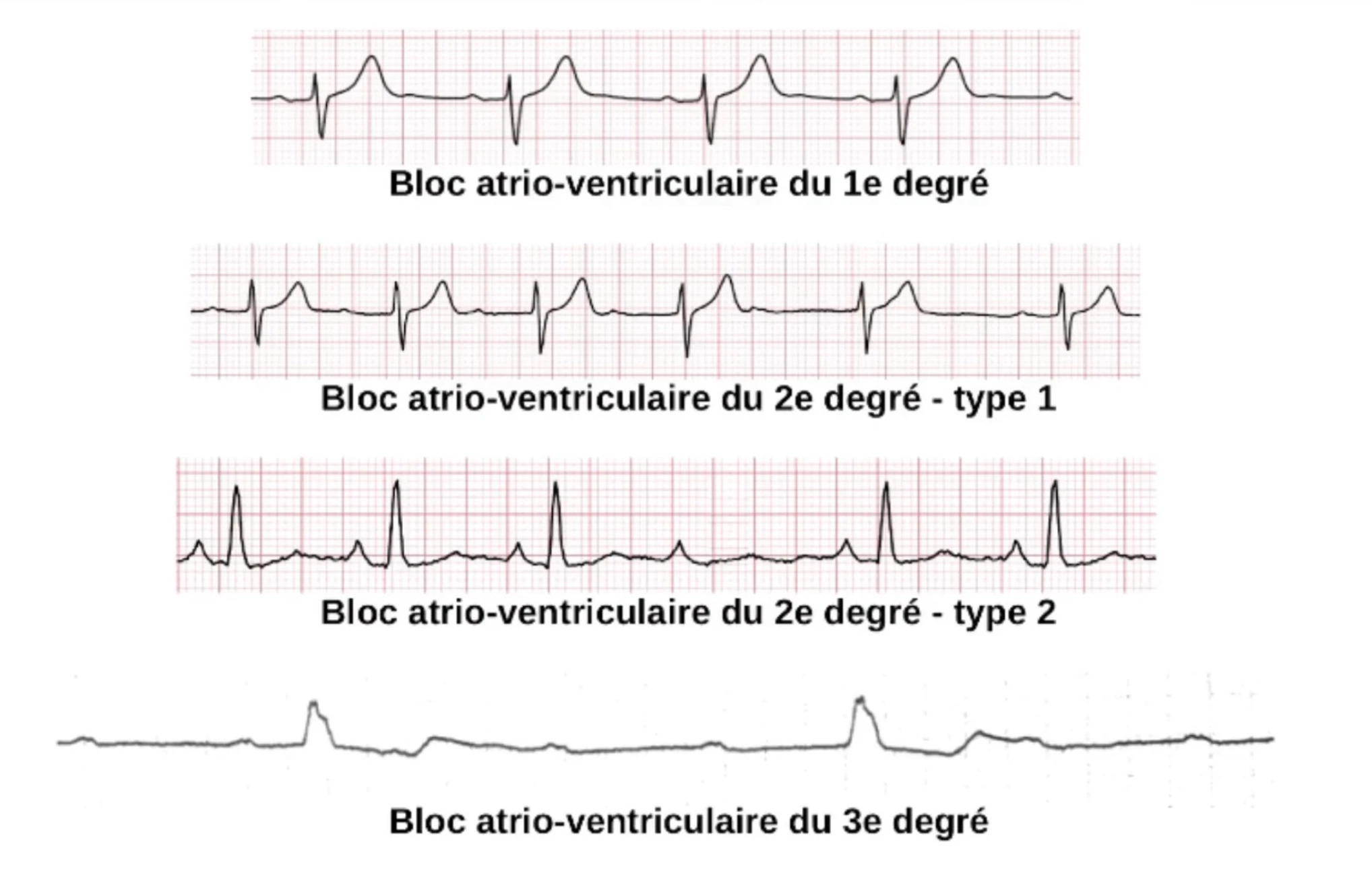 BAV tracings — exemples ECG BAV I, II type 1, II type 2, III
