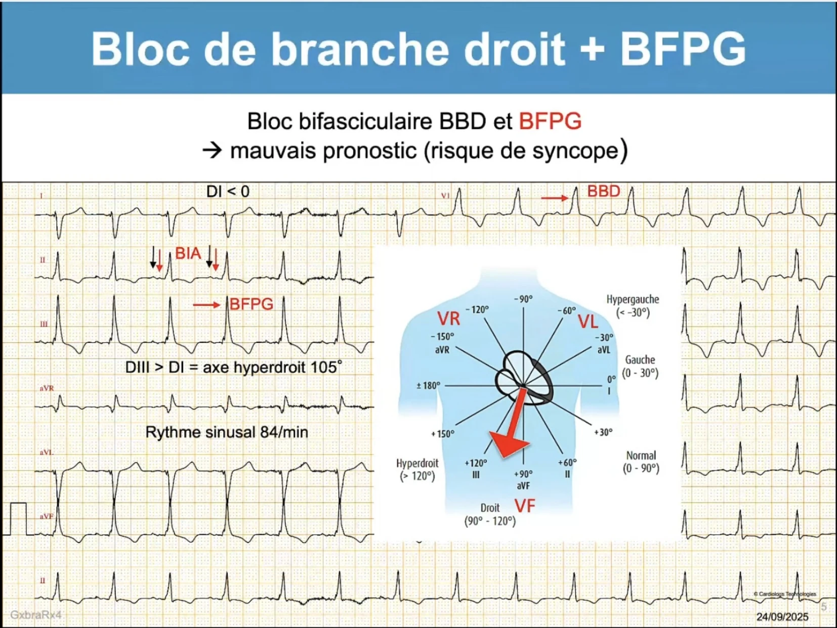 BBD + BFPG — tracé 12 dérivations, bloc bifasciculaire