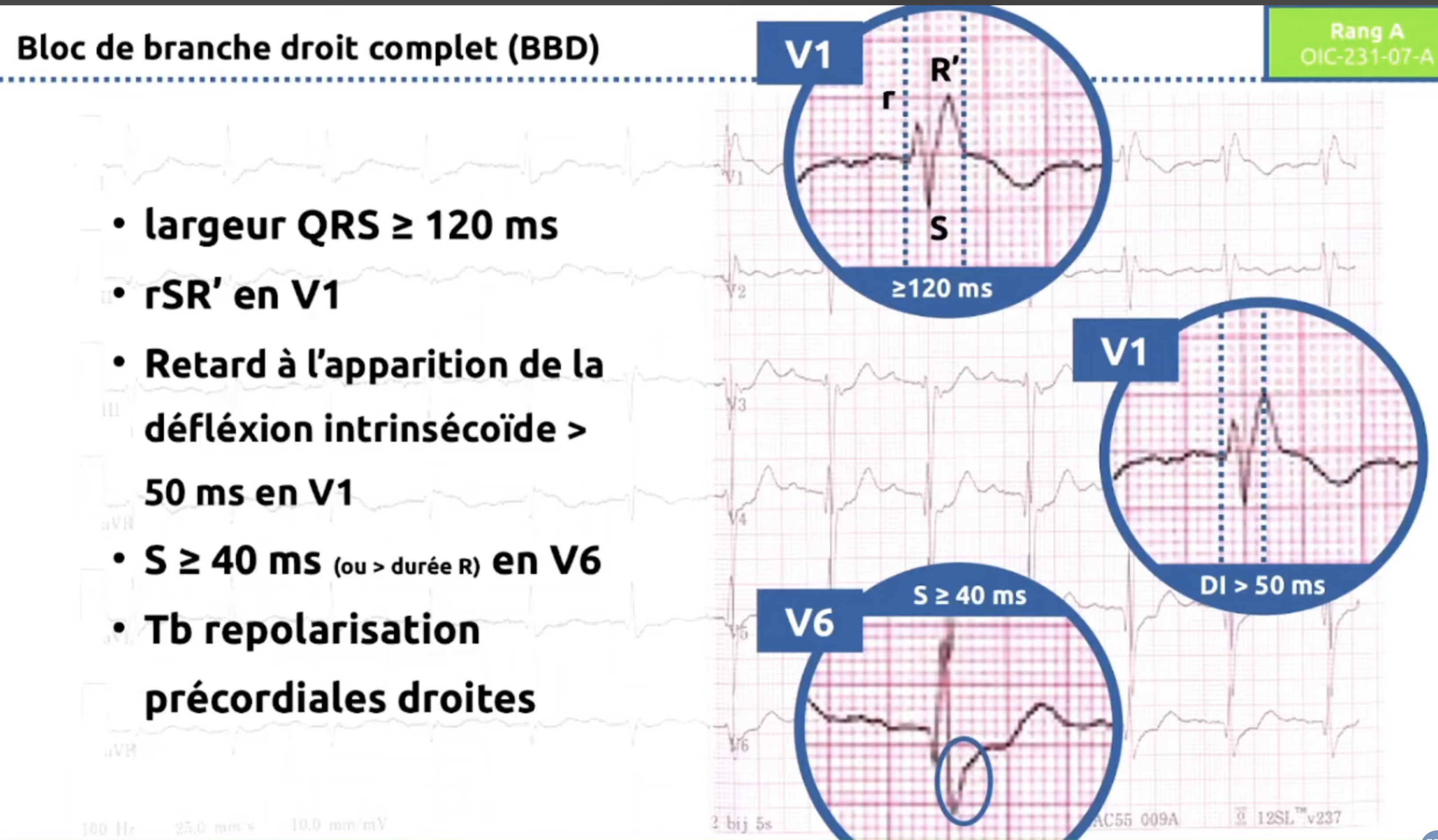 BBD critères ECG et tracés