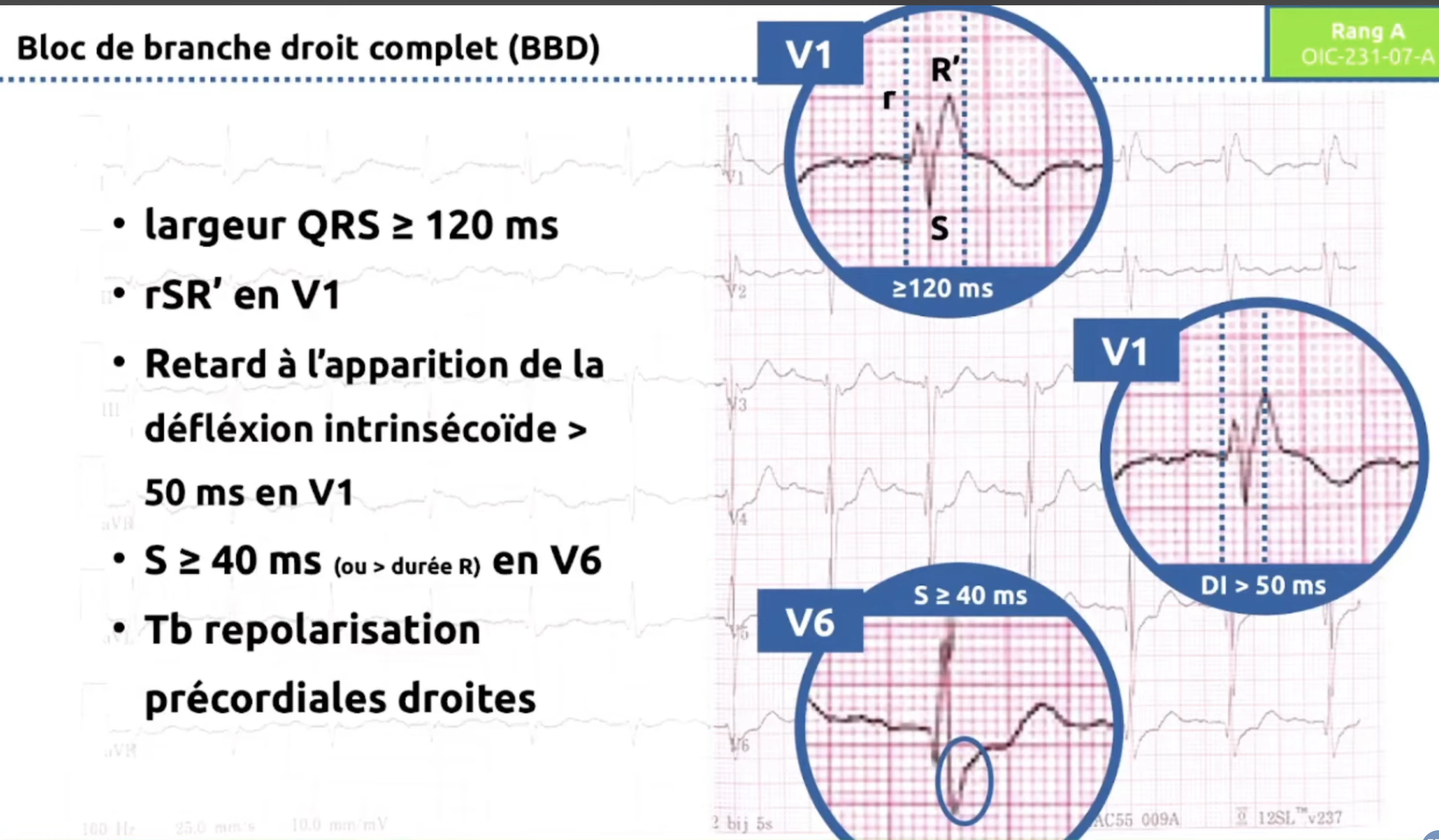 BBD critères ECG et tracés