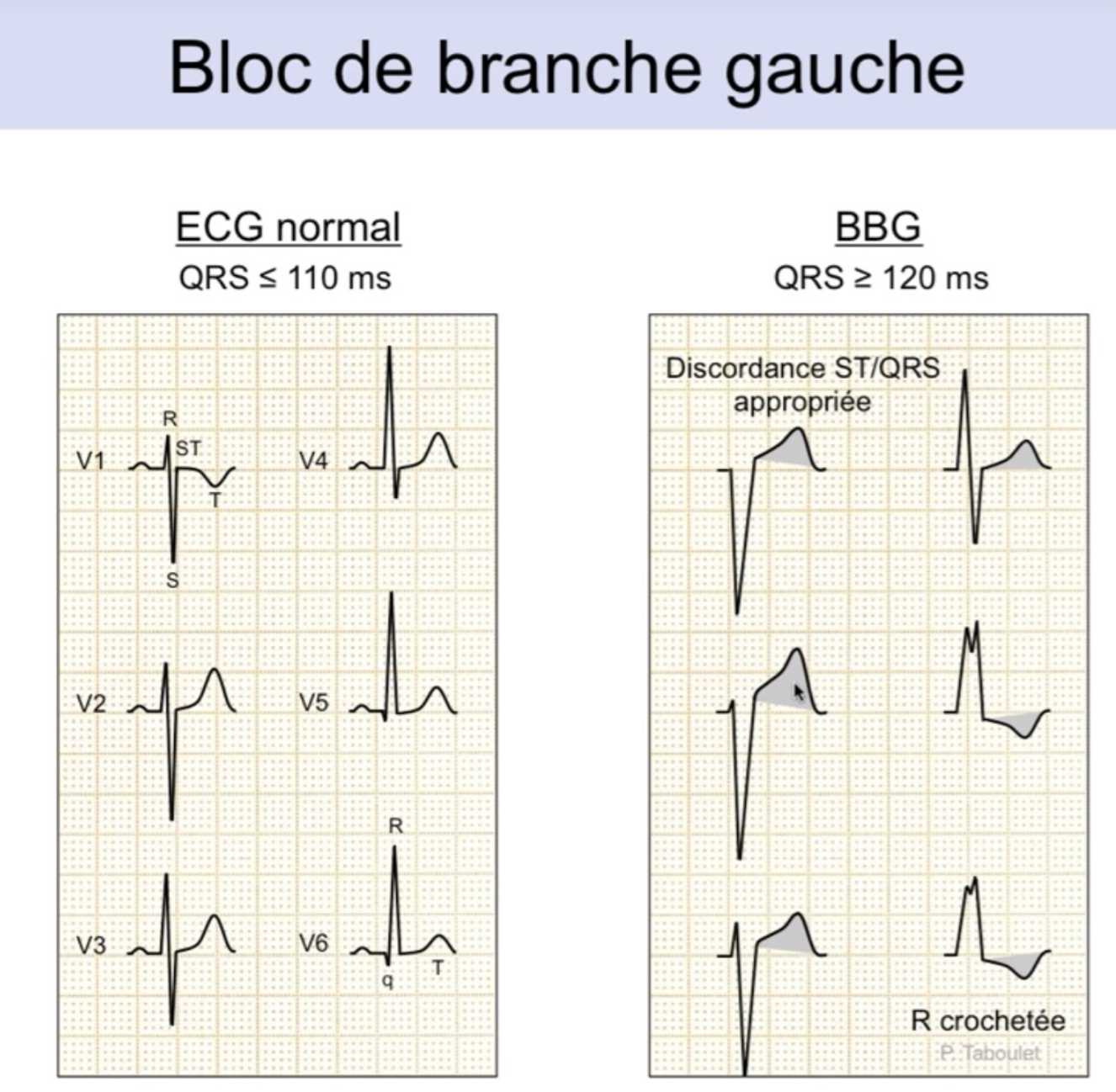 BBG vs ECG normal — QRS ≥ 120ms, discordance ST/QRS appropriée, R crochetée en V6