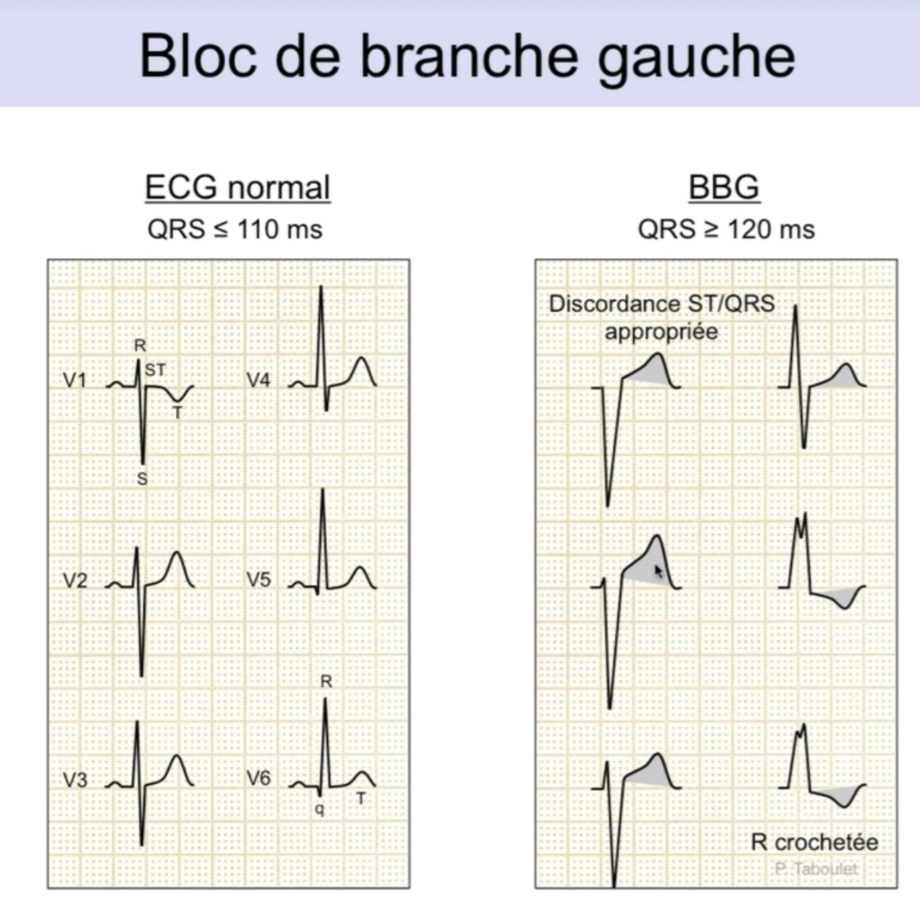 BBG vs ECG normal — QRS ≥ 120ms, discordance ST/QRS appropriée, R crochetée en V6