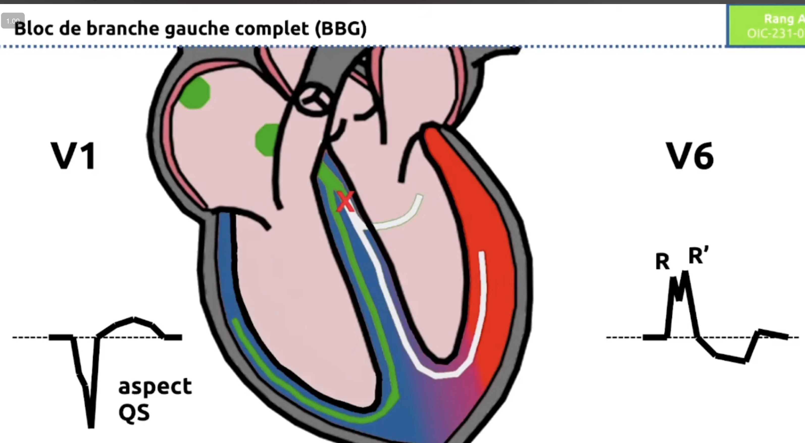 BBG schéma anatomique — aspect QS en V1, RR' en V6