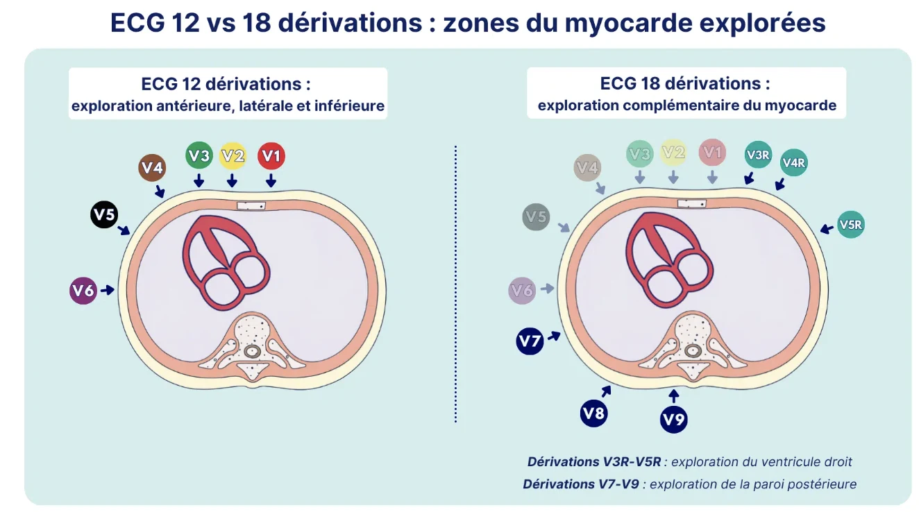 ECG 12 vs 18 dérivations — le 18 dérivations ajoute V3R–V5R (ventricule droit) et V7–V9 (paroi postérieure)