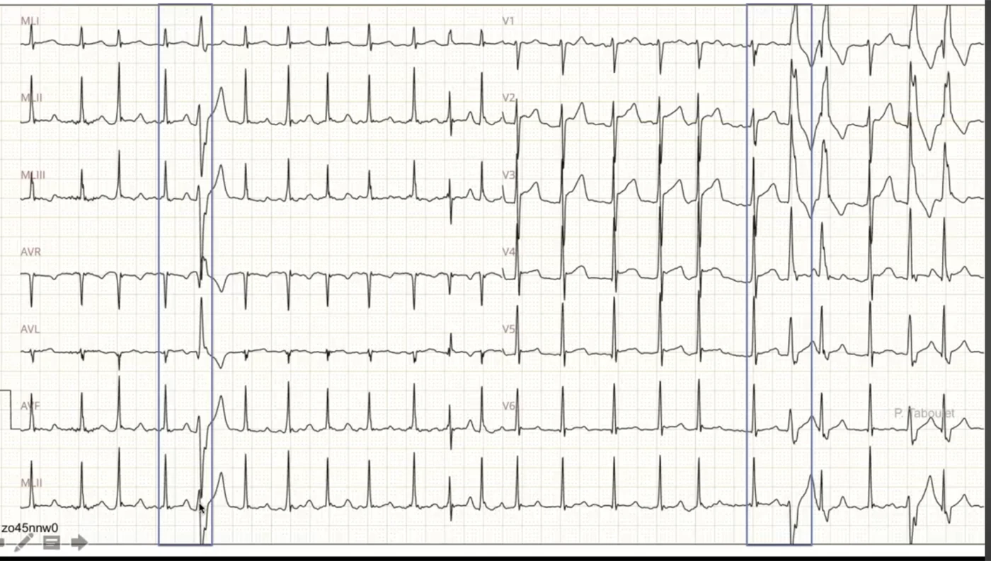 Aberration de conduction sur FA — QRS larges fréquence-dépendants, début du QRS préservé, ondes R similaires dans les dérivations frontales