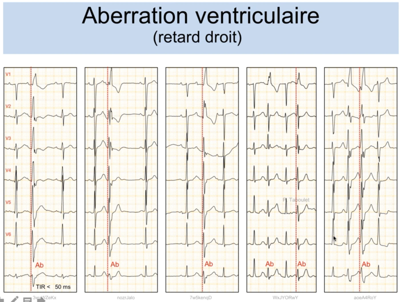 Cinq exemples d'aberration ventriculaire en retard droit (précordiales V1 à V6) — dans chaque colonne l'onde R en V6 reste fine et colle au front de dépolarisation (trait pointillé), temps d'inscription de la R inférieur à 50 ms, tous marqués Ab