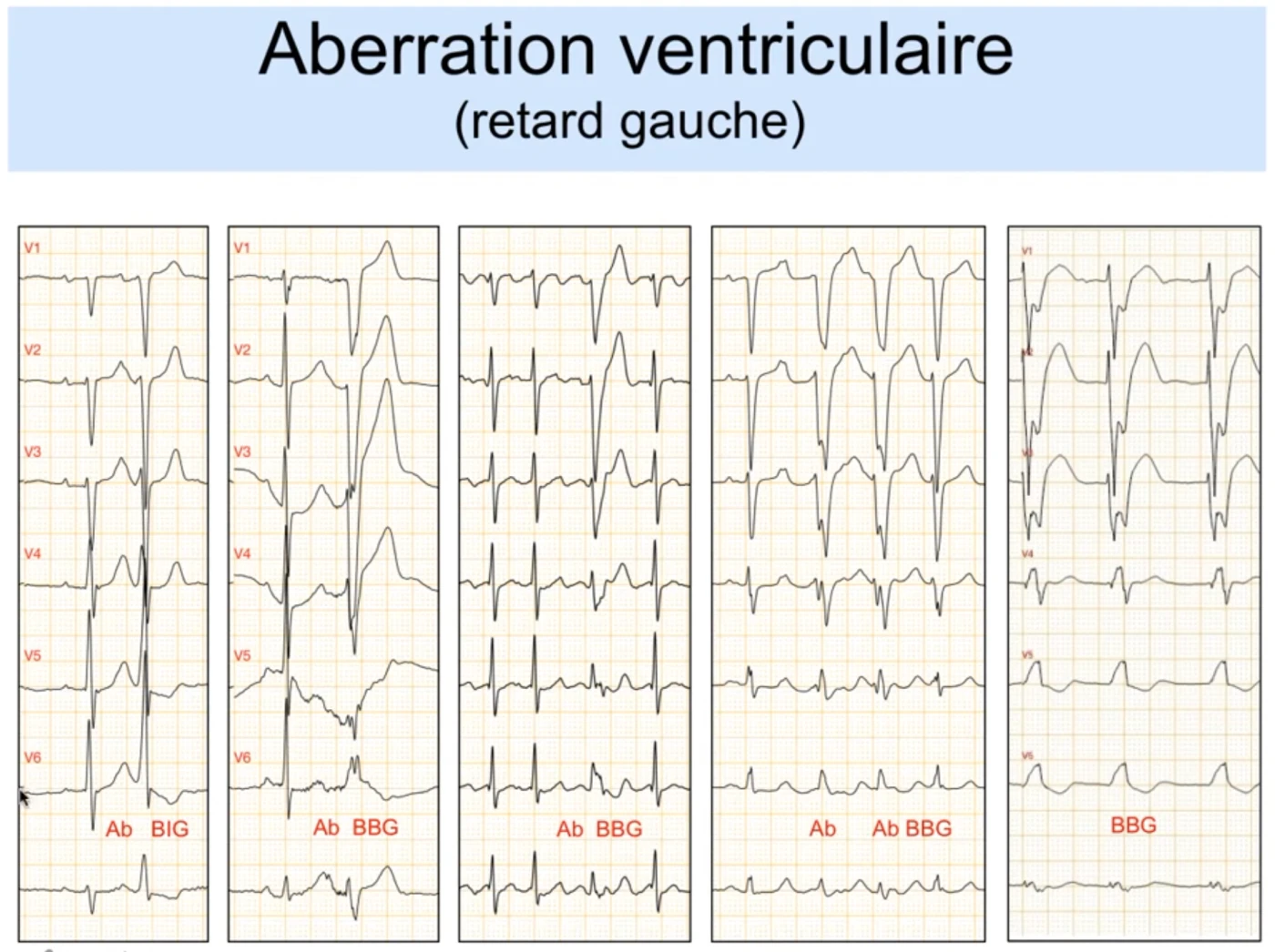 Cinq exemples d'aberration ventriculaire en retard gauche (précordiales V1 à V6) : aberrations de type bloc incomplet gauche (Ab BIG) et bloc de branche gauche fréquence-dépendant (Ab BBG), toutes avec un début de QRS rapide, marquées Ab = rassurantes