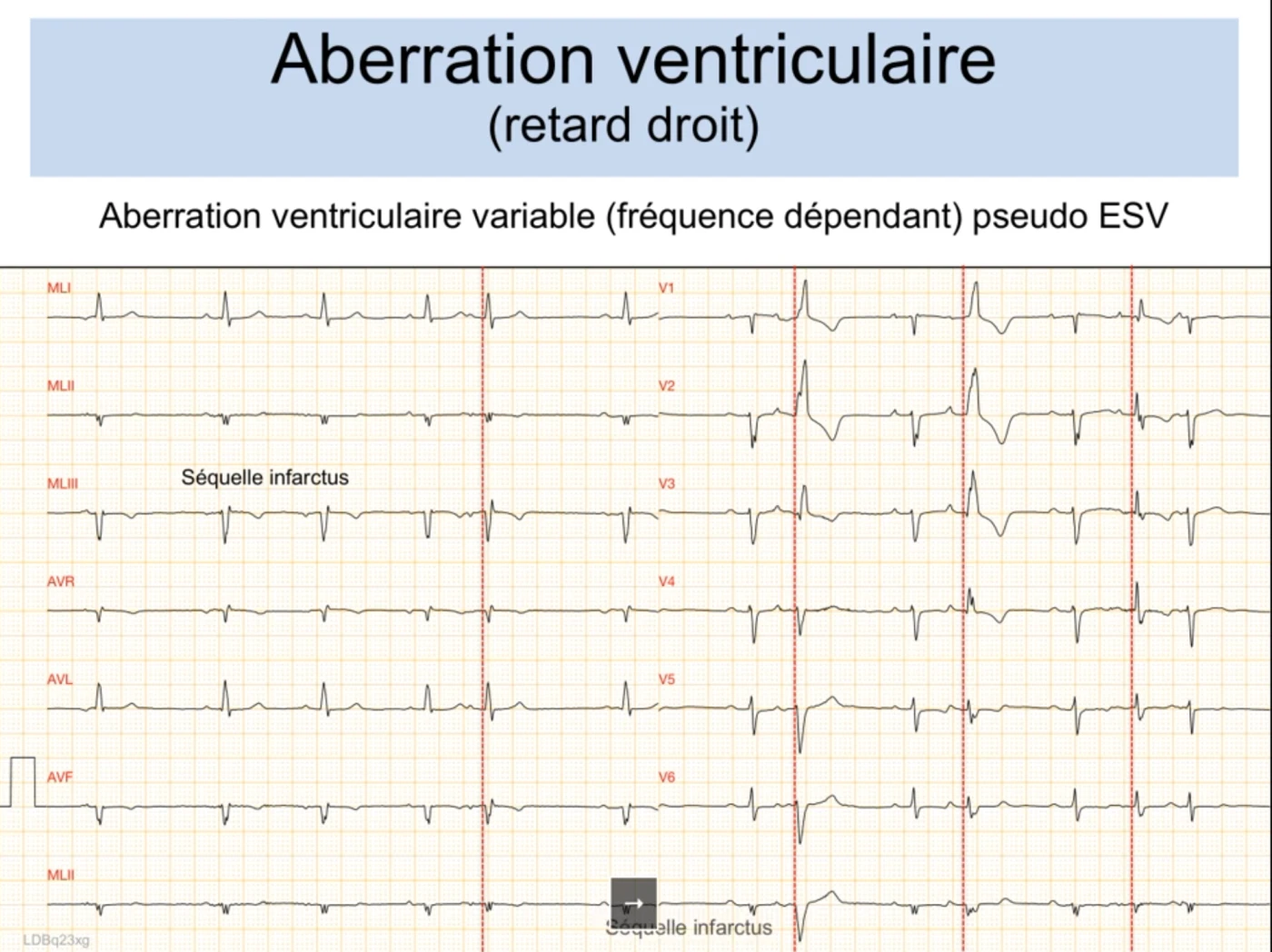 Aberration ventriculaire variable pseudo-ESV (retard droit) sur 12 dérivations, avec séquelle d'infarctus inféro-latérale annotée en DIII et en DII inférieur ; l'onde R des dérivations gauches conduit bien mais reste peu voltée à cause de la séquelle, ce qui rend le tracé trompeur