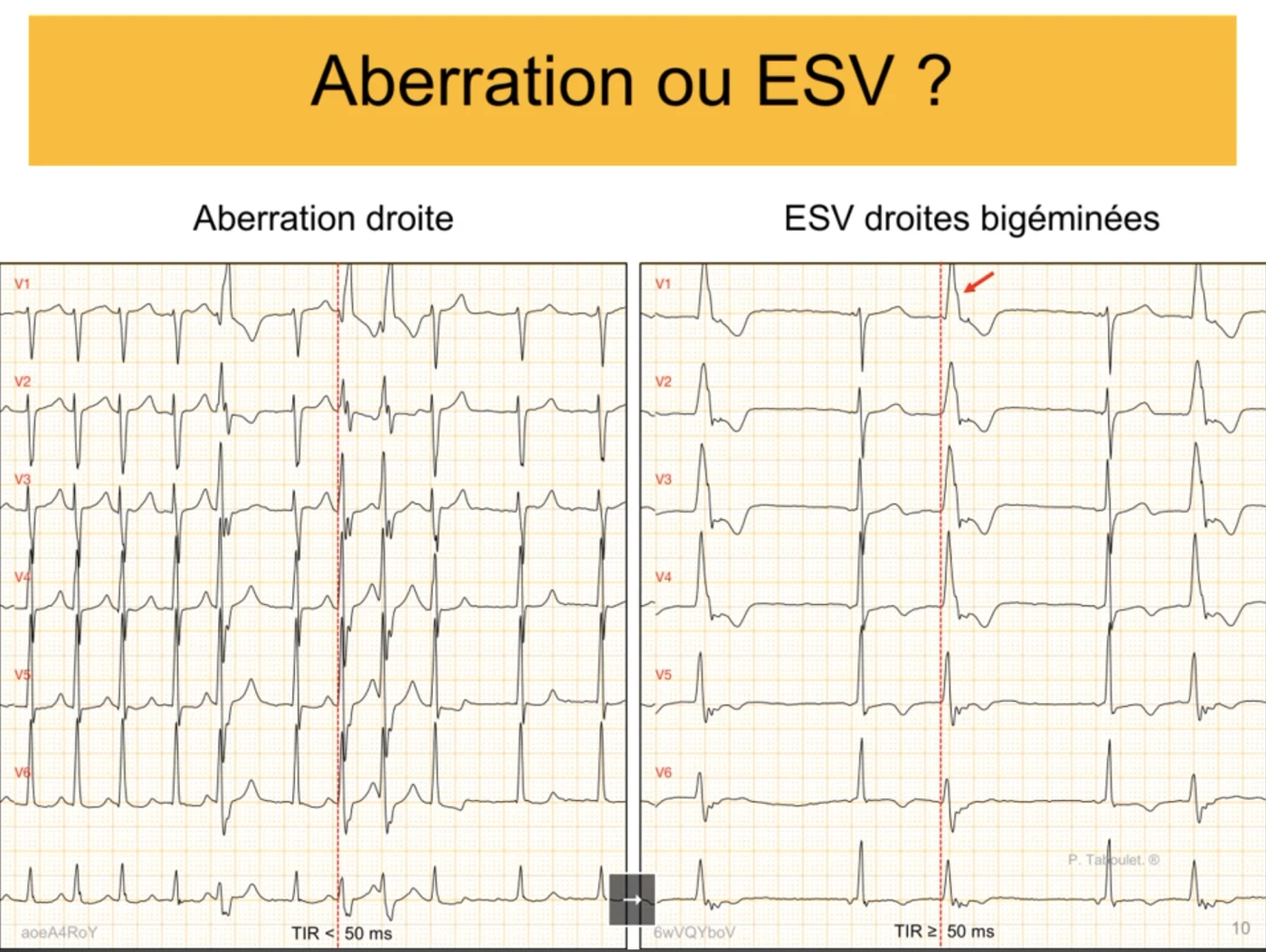 Aberration ou ESV : deux ECG côte à côte en retard droit. À gauche une aberration droite avec temps d'inscription de la R inférieur à 50 ms ; à droite des extrasystoles ventriculaires droites bigéminées avec temps d'inscription de la R supérieur ou égal à 50 ms et flèche sur le retard de la R