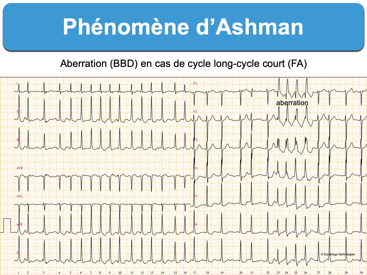 Phénomène d'Ashman — FA avec aberration ventriculaire aspect BBD après long RR