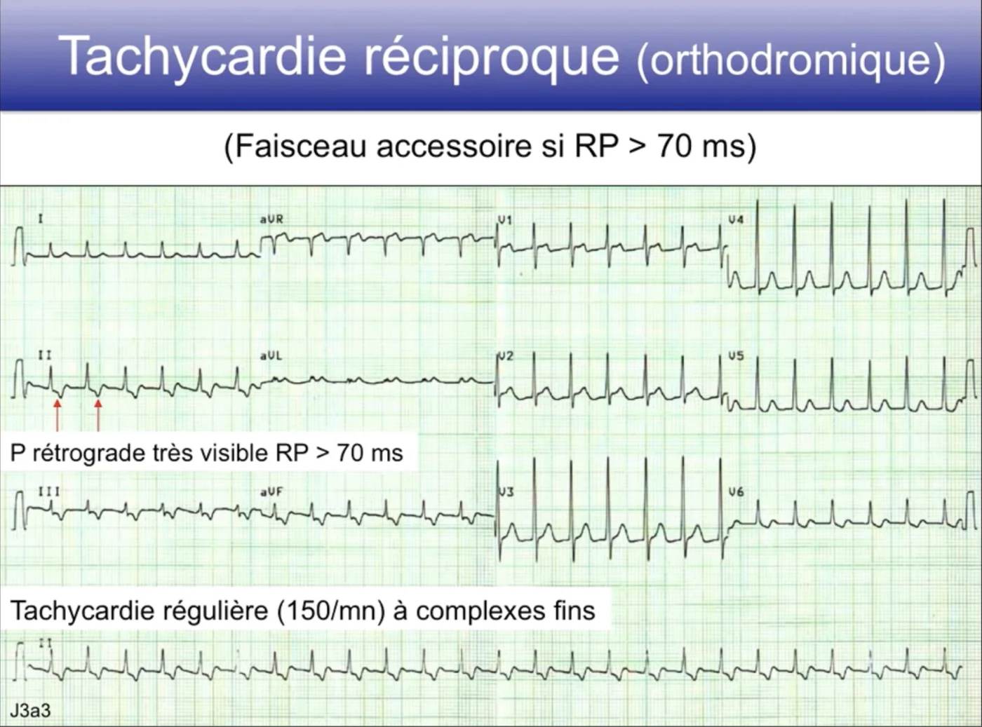 TRAV orthodromique — faisceau accessoire, P rétrograde RP supérieur à 70 ms, tachycardie régulière 150/min QRS fins