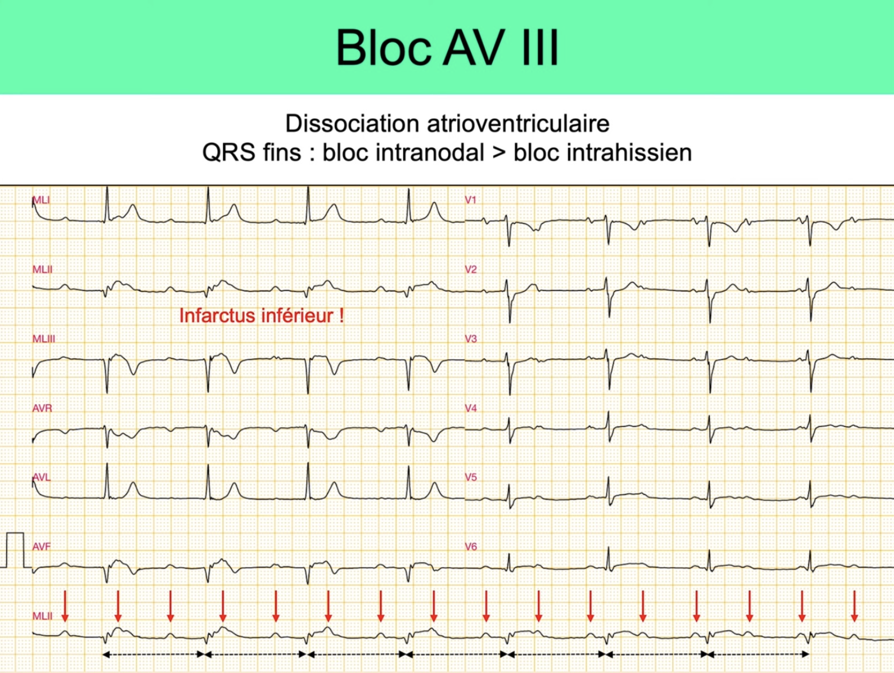 BAV III complet — dissociation AV, P régulières (flèches rouges) et QRS réguliers déconnectés, IDM inférieur
