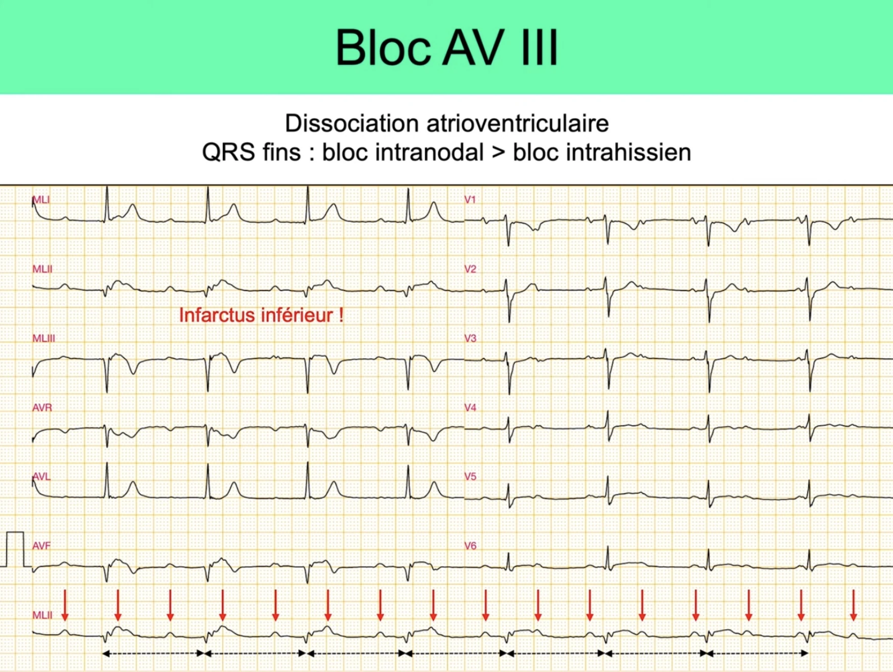 BAV III complet — dissociation AV, P régulières (flèches rouges) et QRS réguliers déconnectés, IDM inférieur