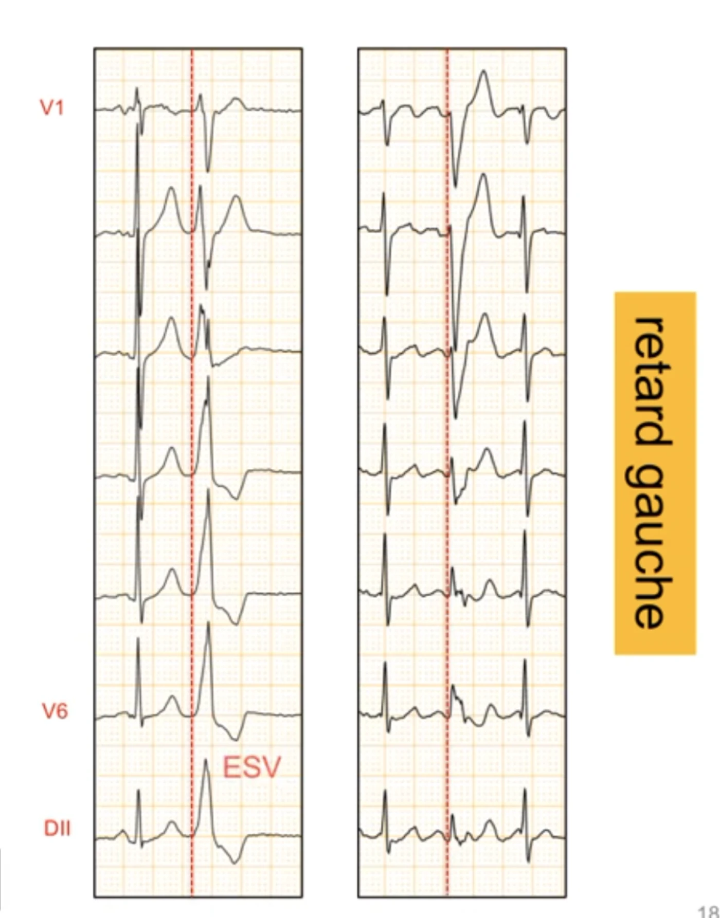 Comparaison en retard gauche, colonnes V1 à V6 et DII : à gauche une extrasystole ventriculaire, à droite un vrai bloc de branche gauche ; les deux ont une onde R monophasique en V6, mais l'extrasystole a un début de QRS lent et empâté avec sommet de R retardé alors que le bloc de branche gauche a un début rapide et net