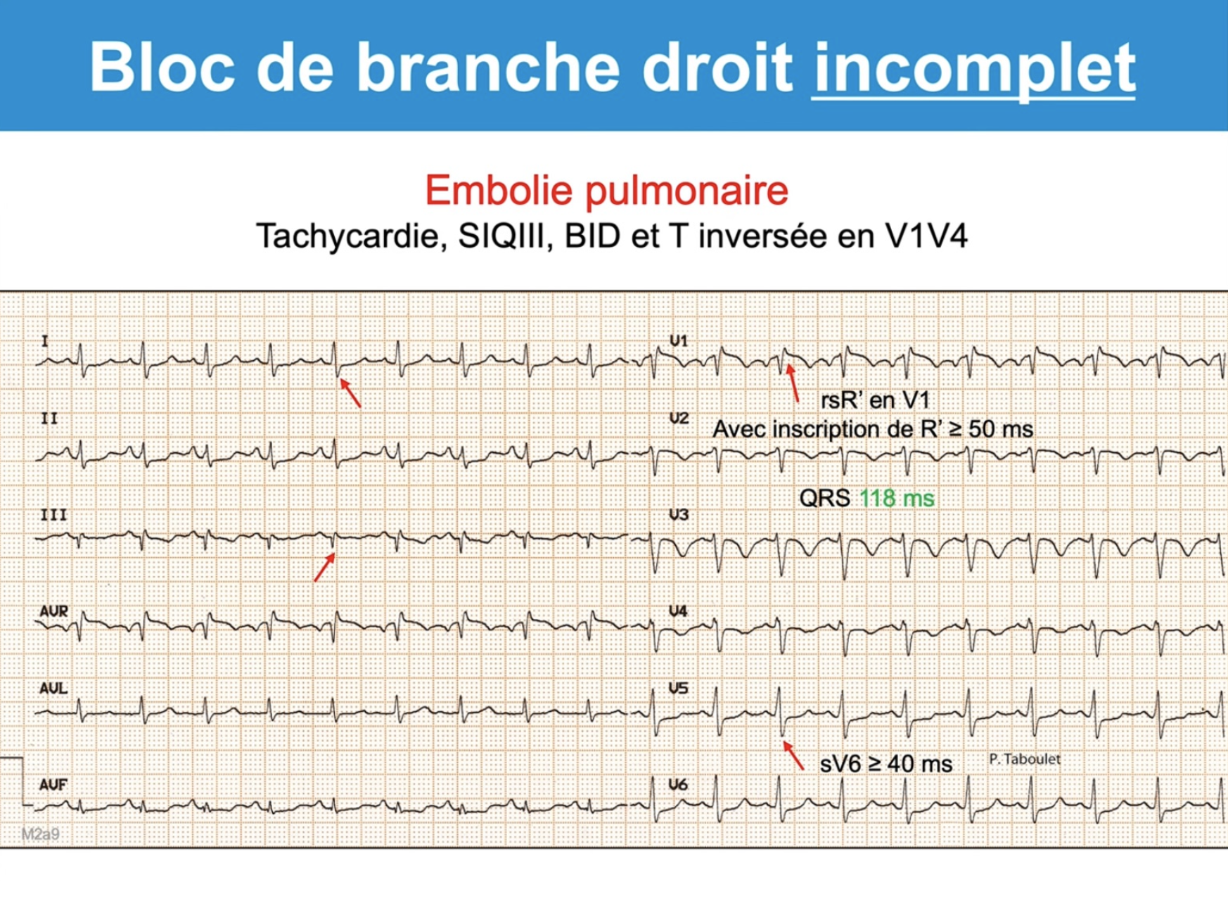 BID dans contexte d'embolie pulmonaire — tachycardie, SIQIII, rsR' V1, QRS 118ms, T négatives V1-V4