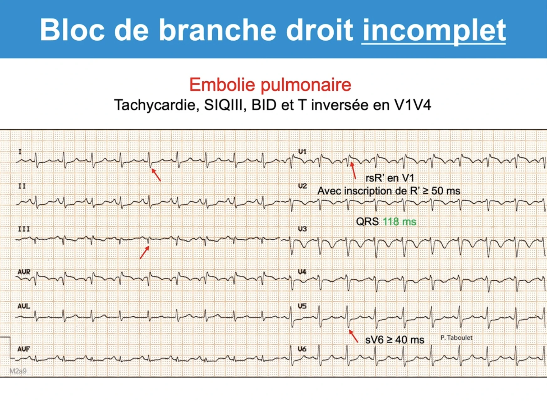 BID dans contexte d'embolie pulmonaire — tachycardie, SIQIII, rsR' V1, QRS 118ms, T négatives V1-V4
