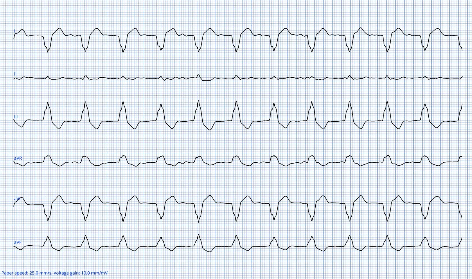 ECG 01 — dérivations des membres (DI à aVF)