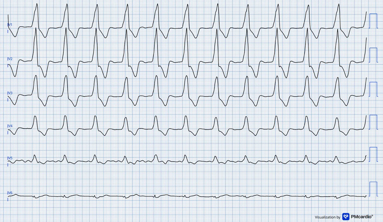 ECG 01 — dérivations précordiales (V1 à V6)