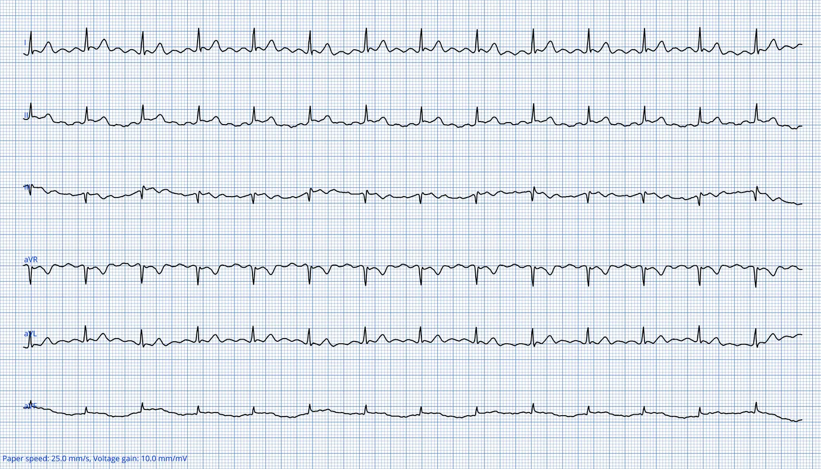 ECG 02 — dérivations des membres (DI à aVF)