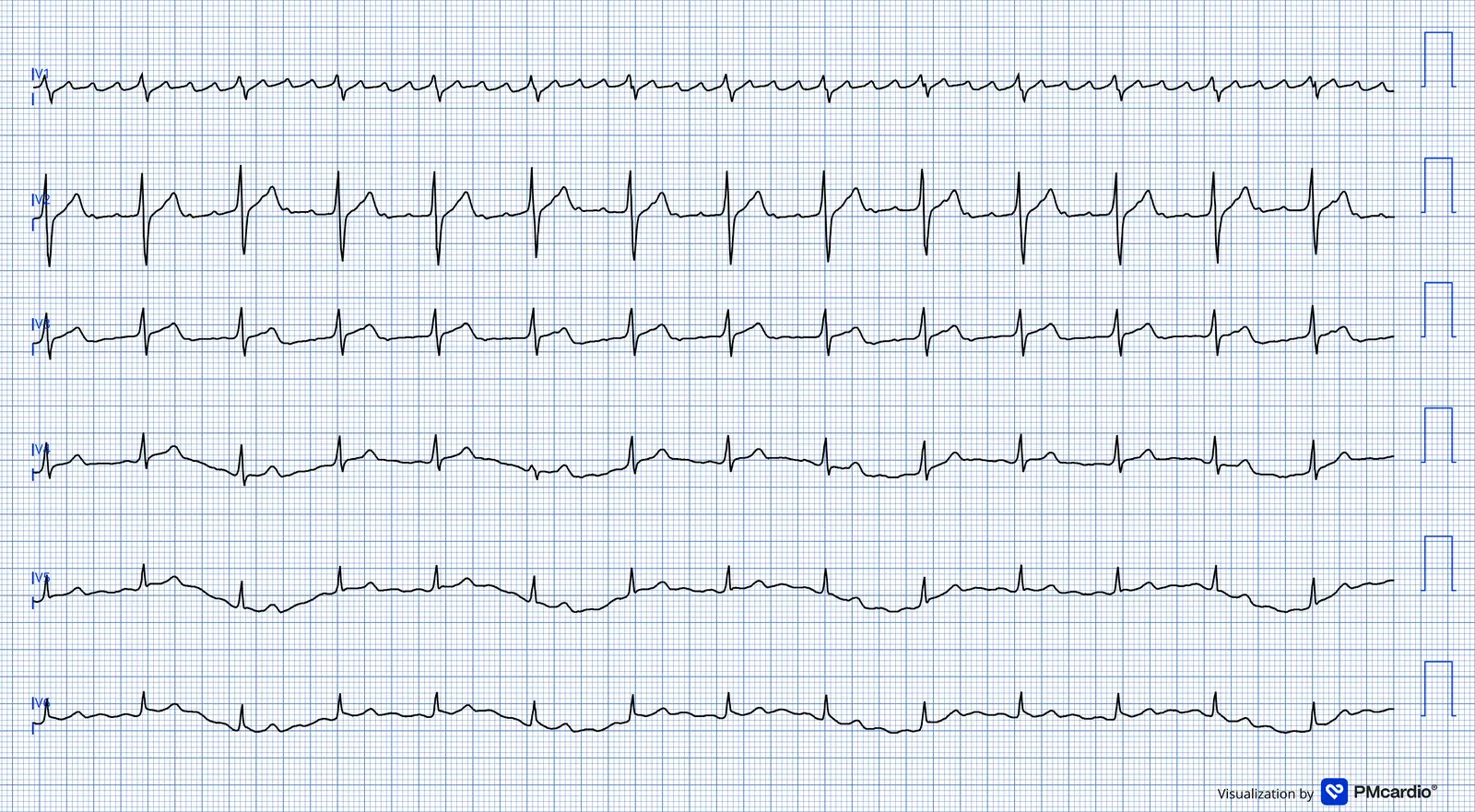 ECG 02 — dérivations précordiales (V1 à V6)