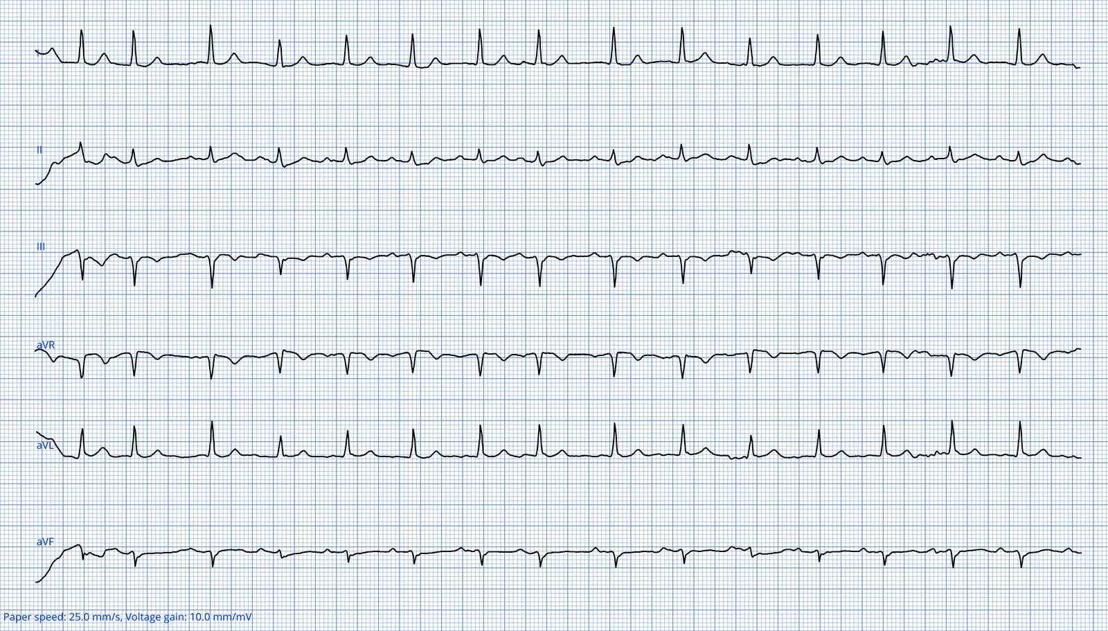 ECG 03 — dérivations des membres (DI à aVF)