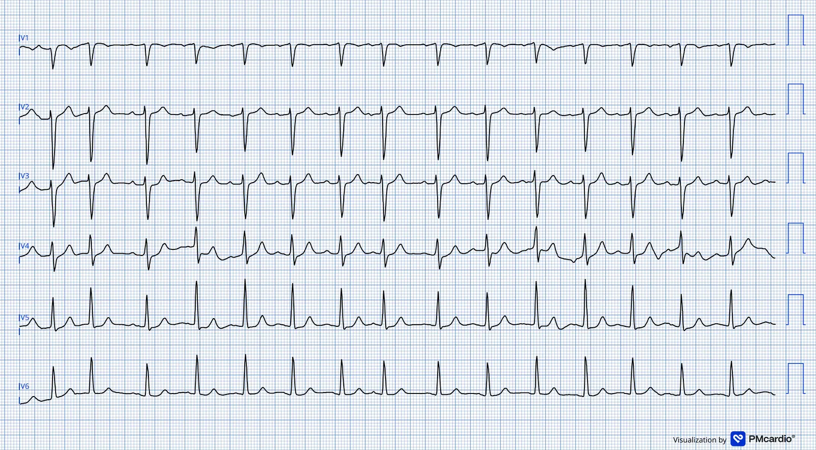 ECG 03 — dérivations précordiales (V1 à V6)