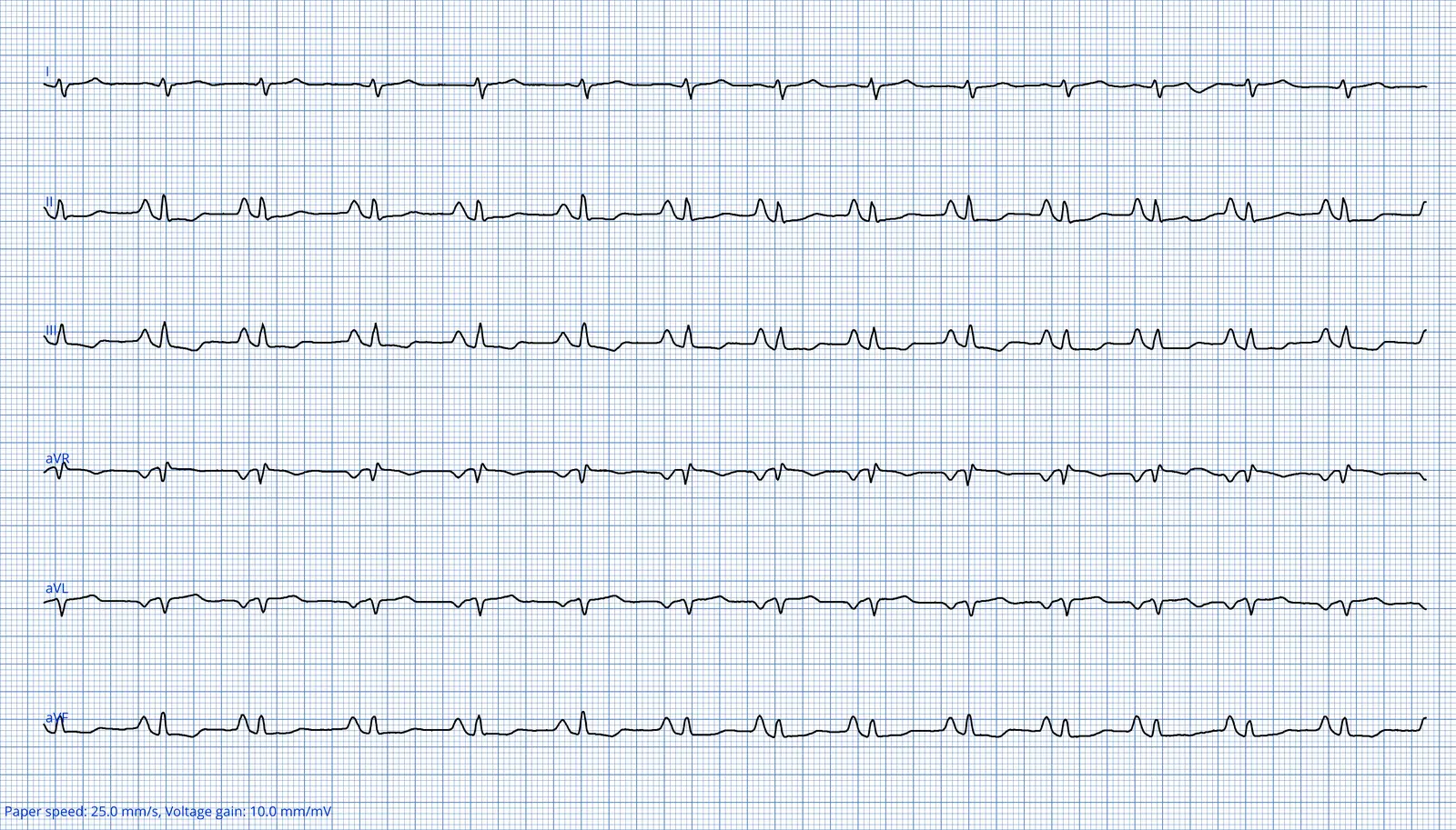 ECG 04 — dérivations des membres (DI à aVF)