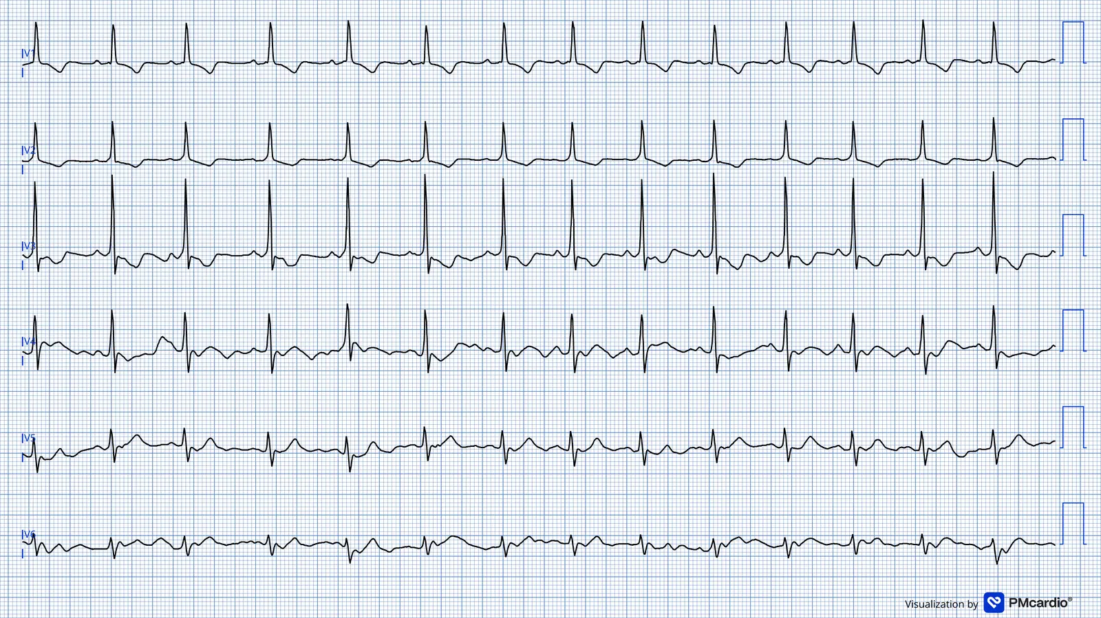ECG 04 — dérivations précordiales (V1 à V6)