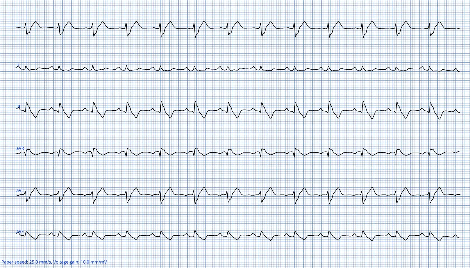 ECG 05 — dérivations des membres (DI à aVF)