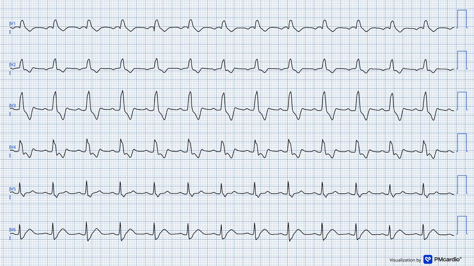 ECG 05 — dérivations précordiales (V1 à V6)