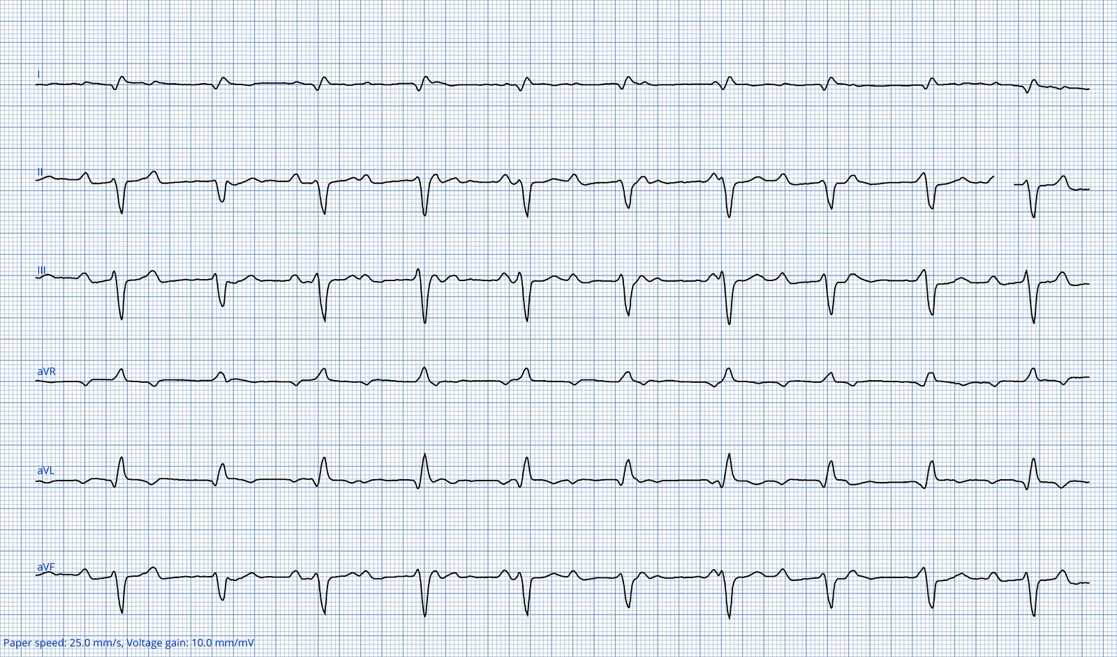 ECG 06 — dérivations des membres (DI à aVF)