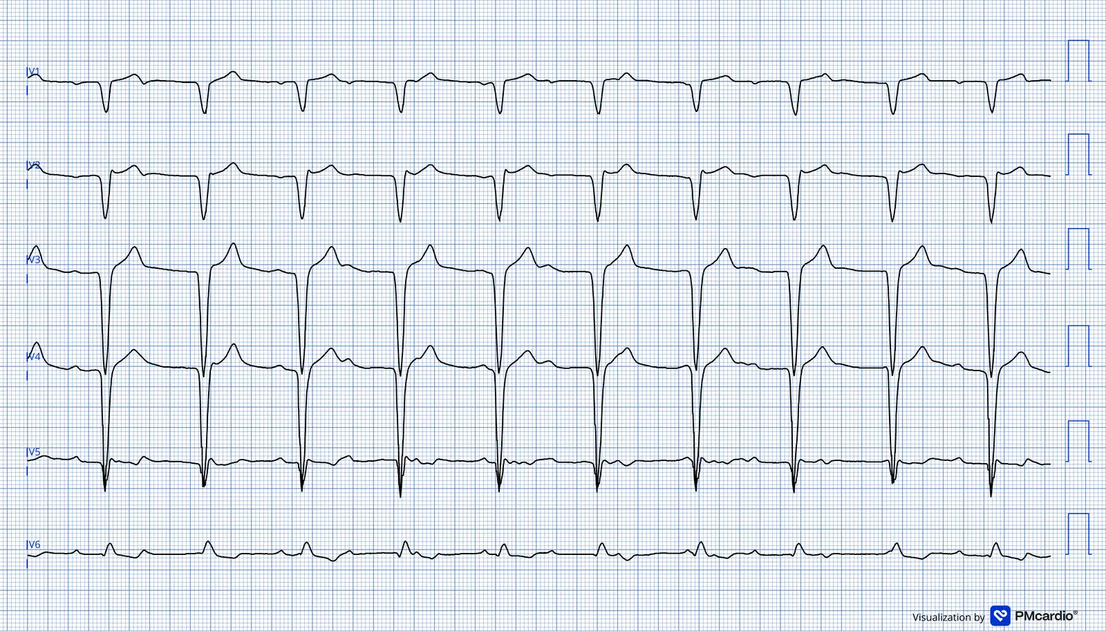 ECG 06 — dérivations précordiales (V1 à V6)