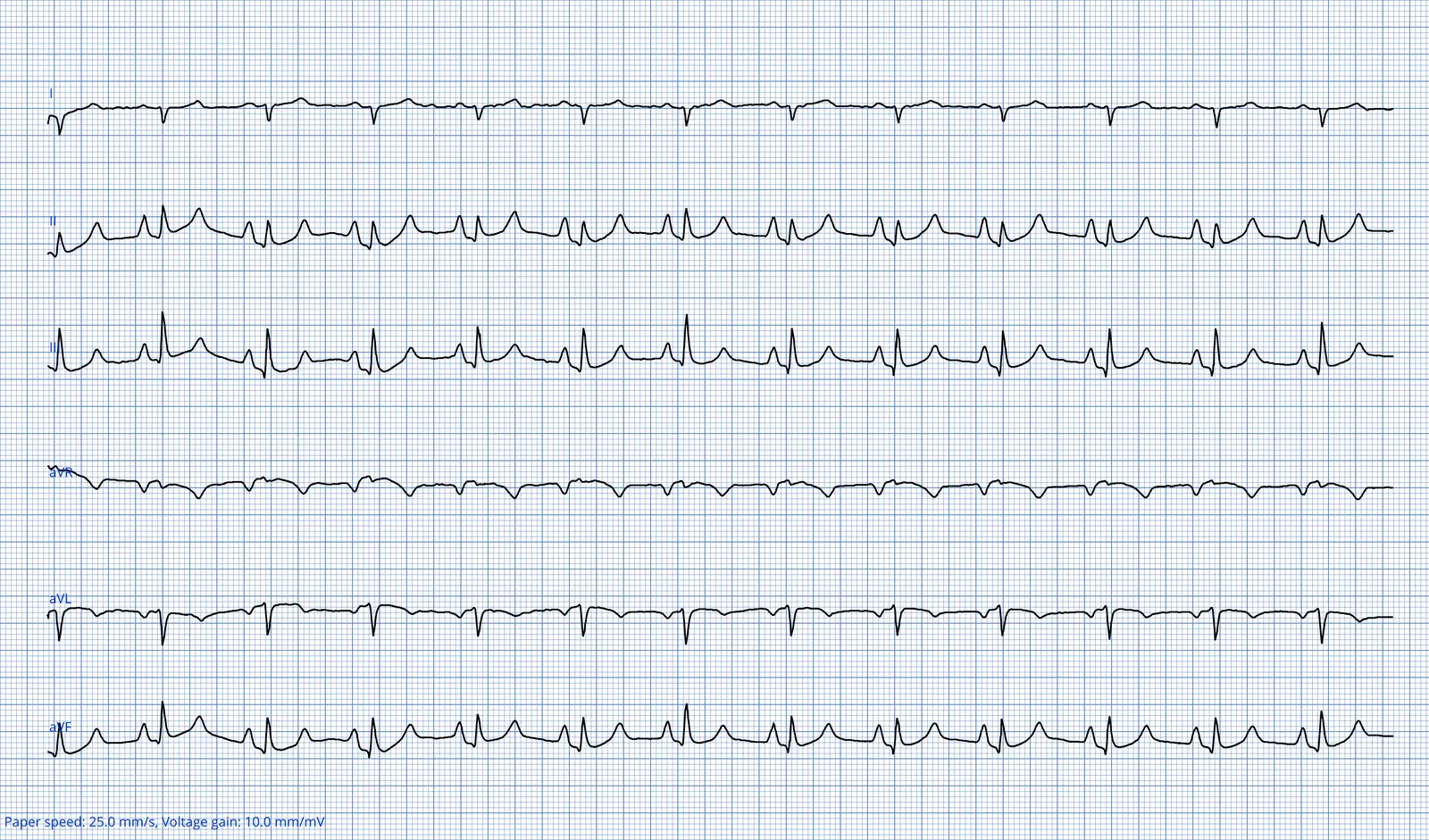 ECG 07 — dérivations des membres (DI à aVF)