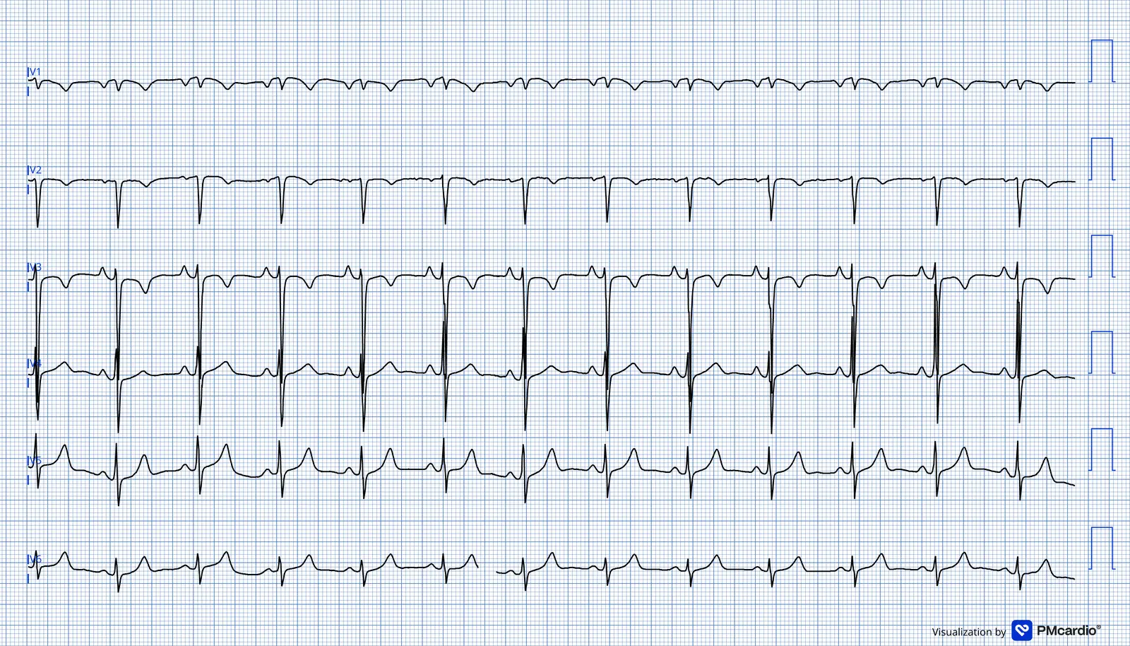 ECG 07 — dérivations précordiales (V1 à V6)