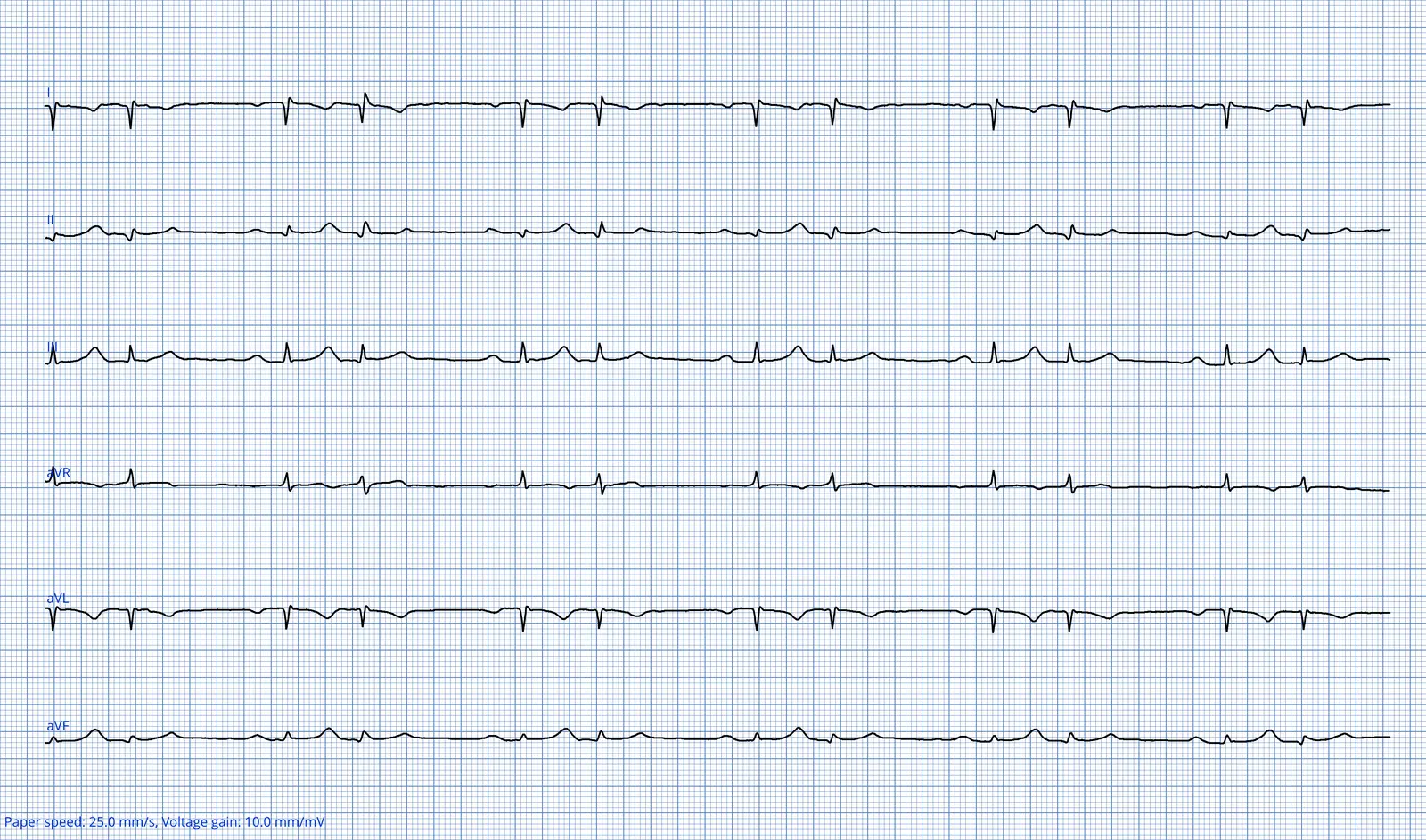 ECG 08 — dérivations des membres (DI à aVF)