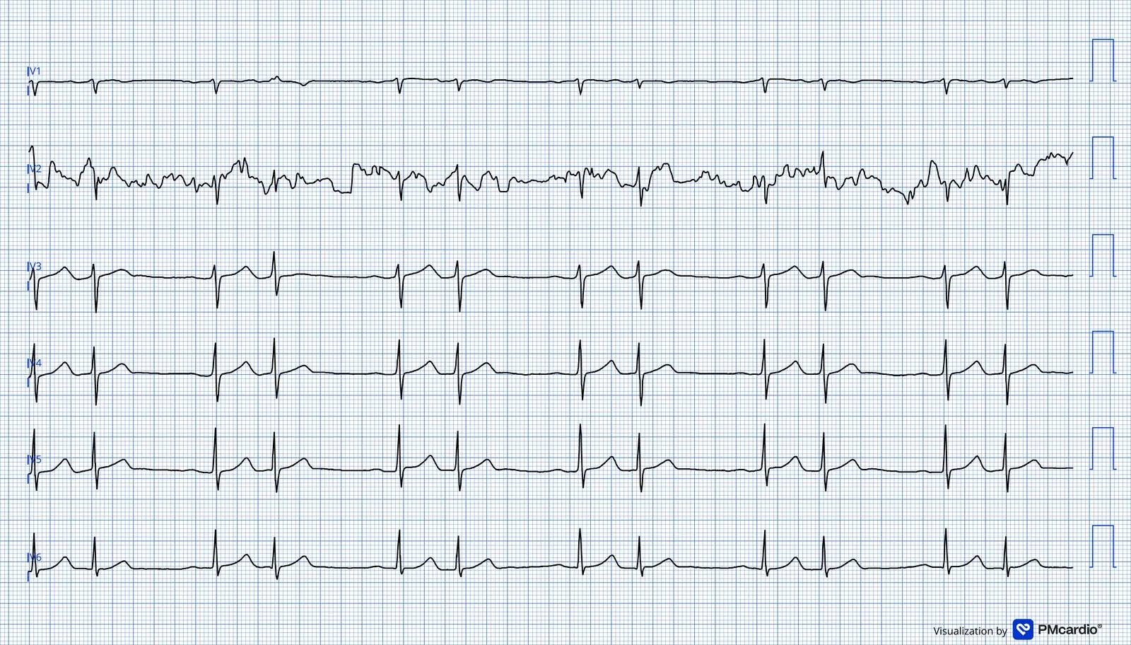 ECG 08 — dérivations précordiales (V1 à V6)