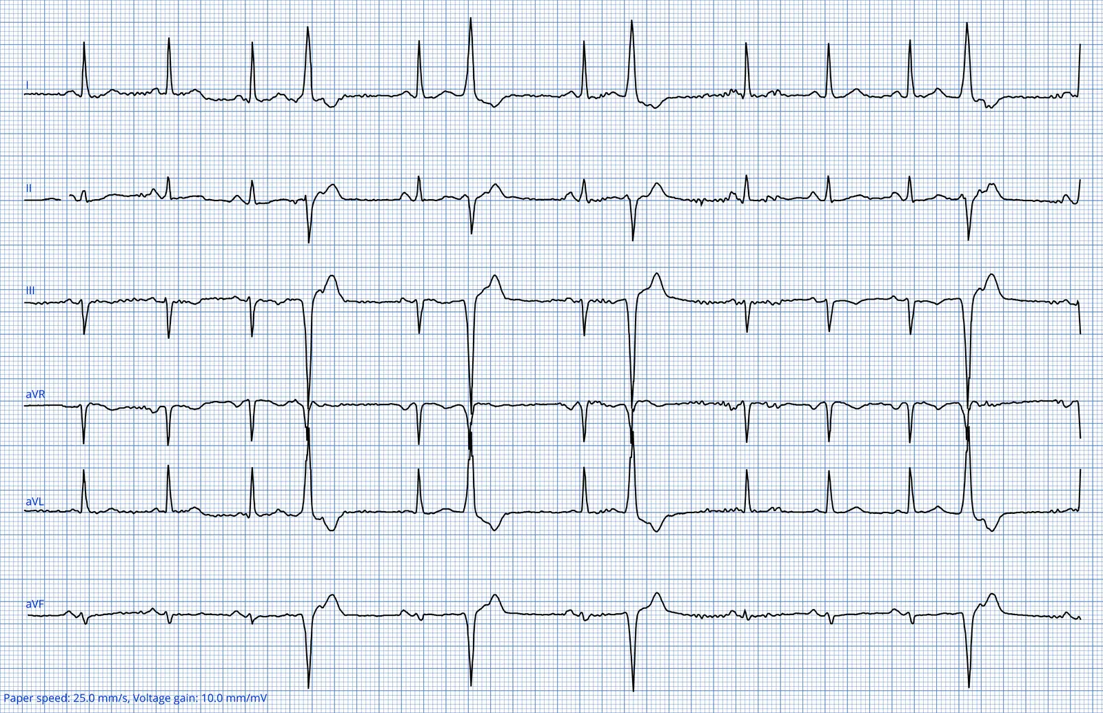 ECG 09 — dérivations des membres (DI à aVF)