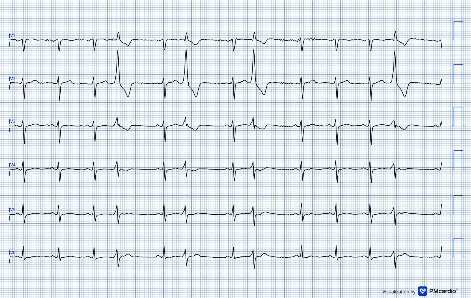 ECG 09 — dérivations précordiales (V1 à V6)