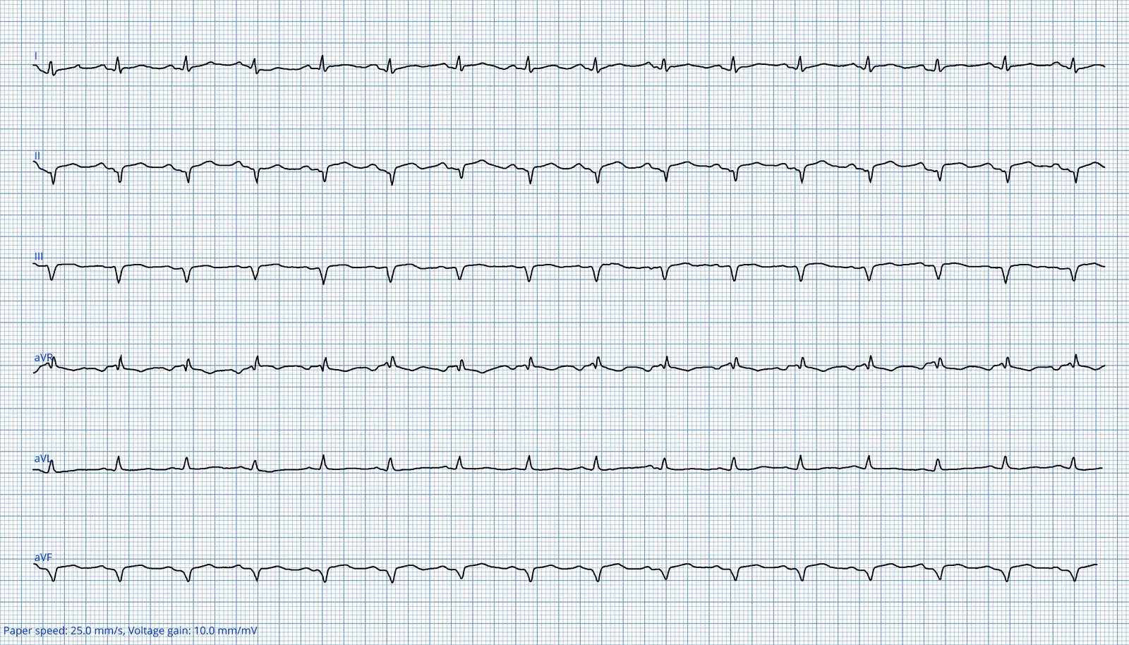 ECG 10 — dérivations des membres (DI à aVF)