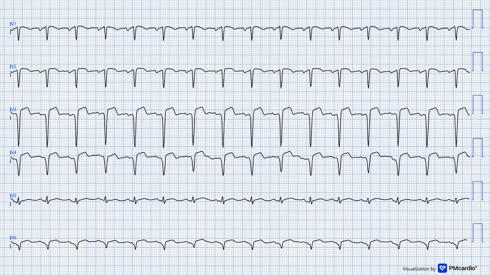 ECG 10 — dérivations précordiales (V1 à V6)