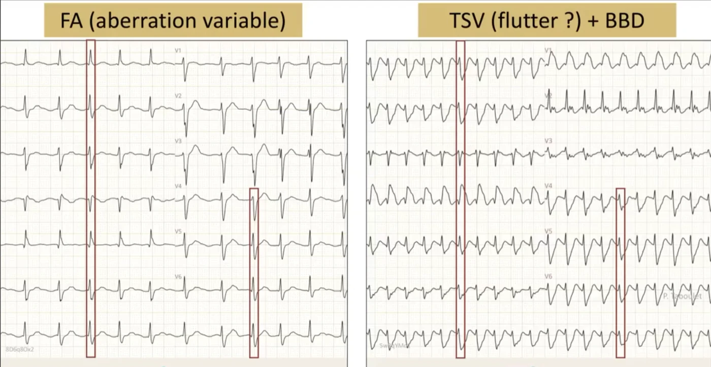 Comparaison en précordiales V1 à V6 — à gauche FA avec aberration variable, à droite TSV (flutter?) avec bloc de branche droit ; début du QRS identique confirmant une aberration