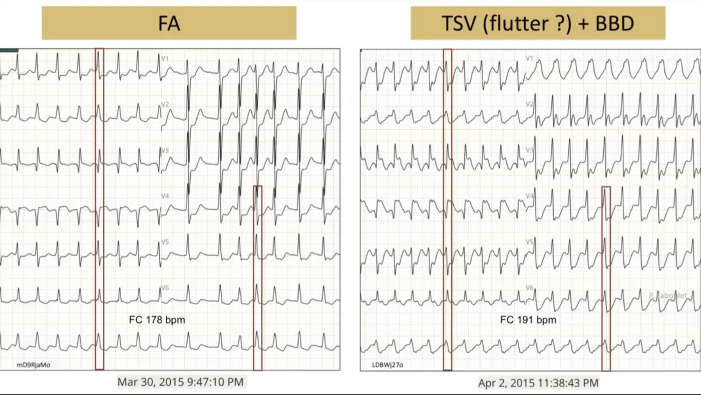 Comparaison de deux ECG du même patient à 3 jours — à gauche FA à 178/min, à droite TSV (flutter?) à 191/min avec bloc de branche droit ; portion initiale du QRS identique, seule la fin est modifiée, confirmant une aberration et non une TV