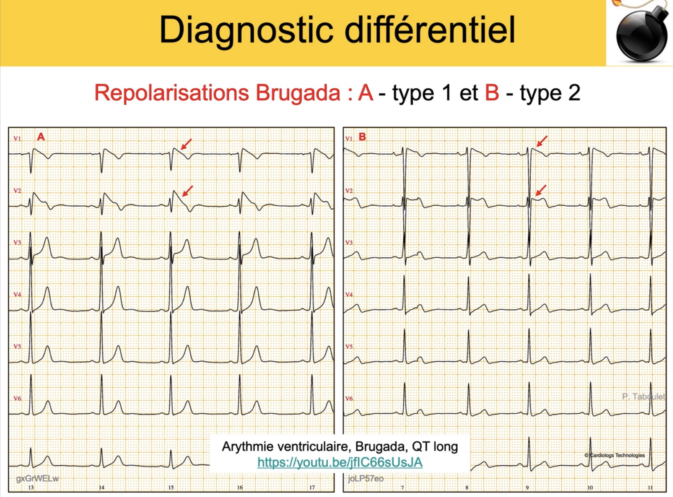 Brugada type 1 vs type 2