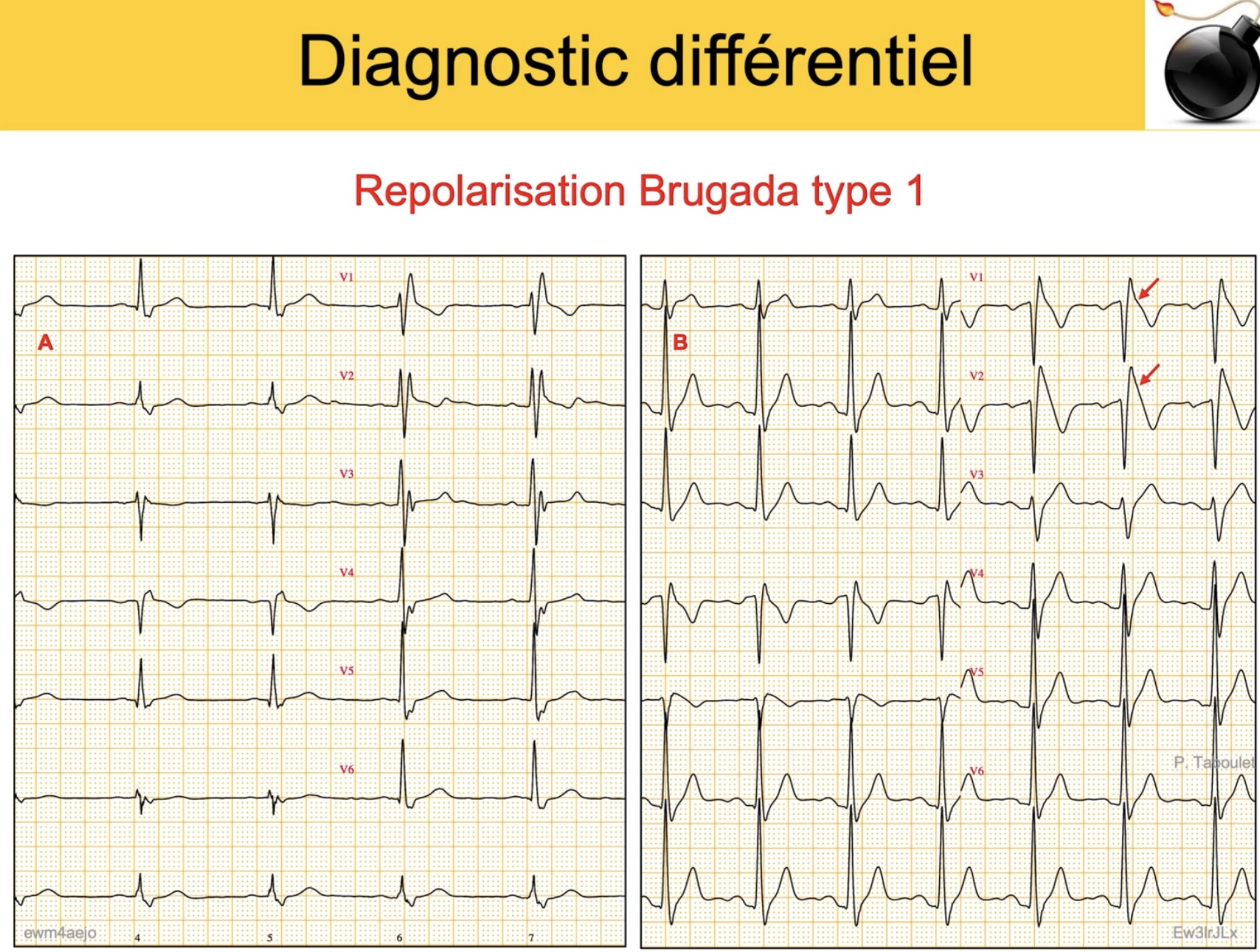 BBD vs Brugada type 1