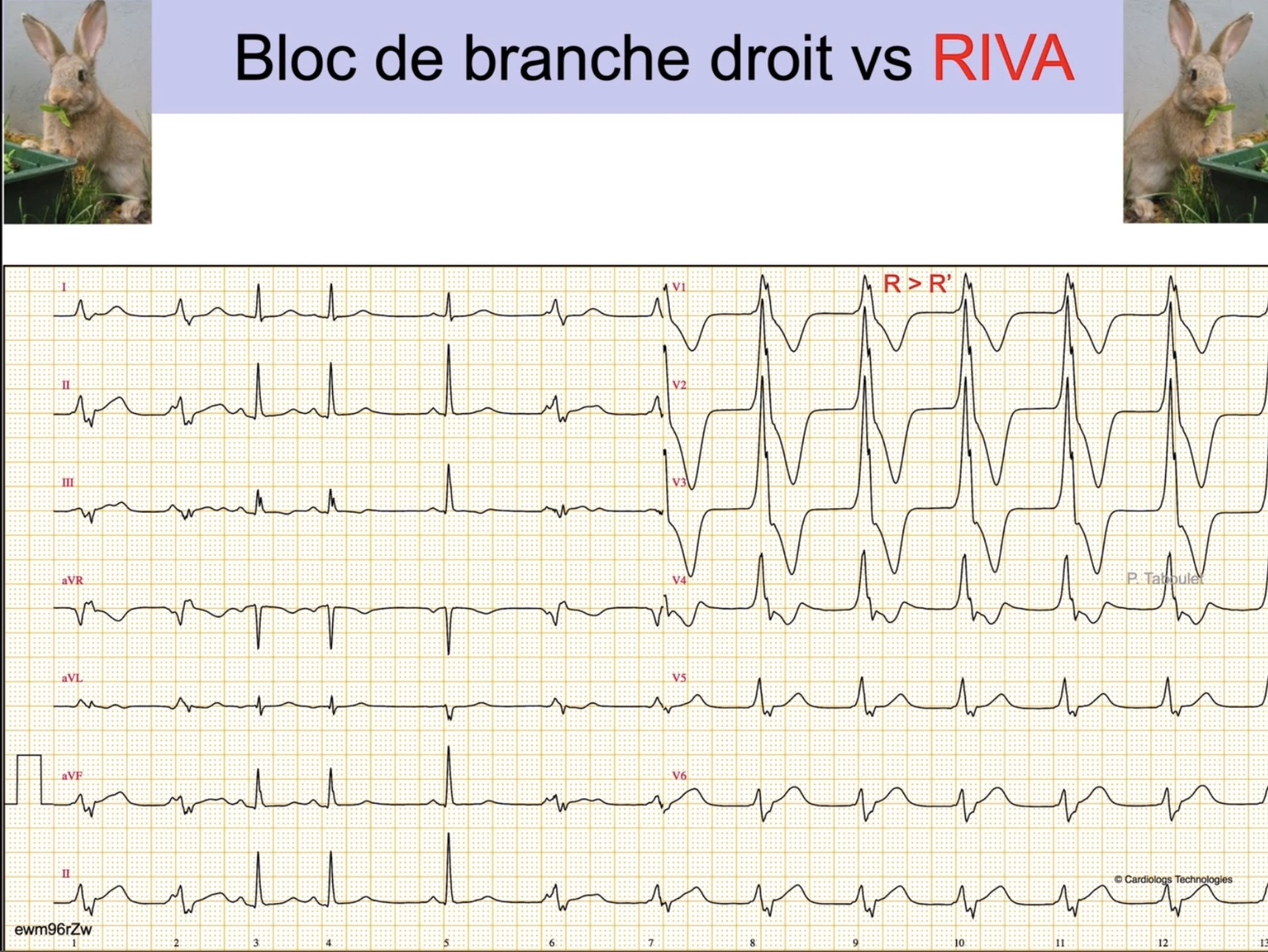 RIVA — transition sinusal vers ventriculaire