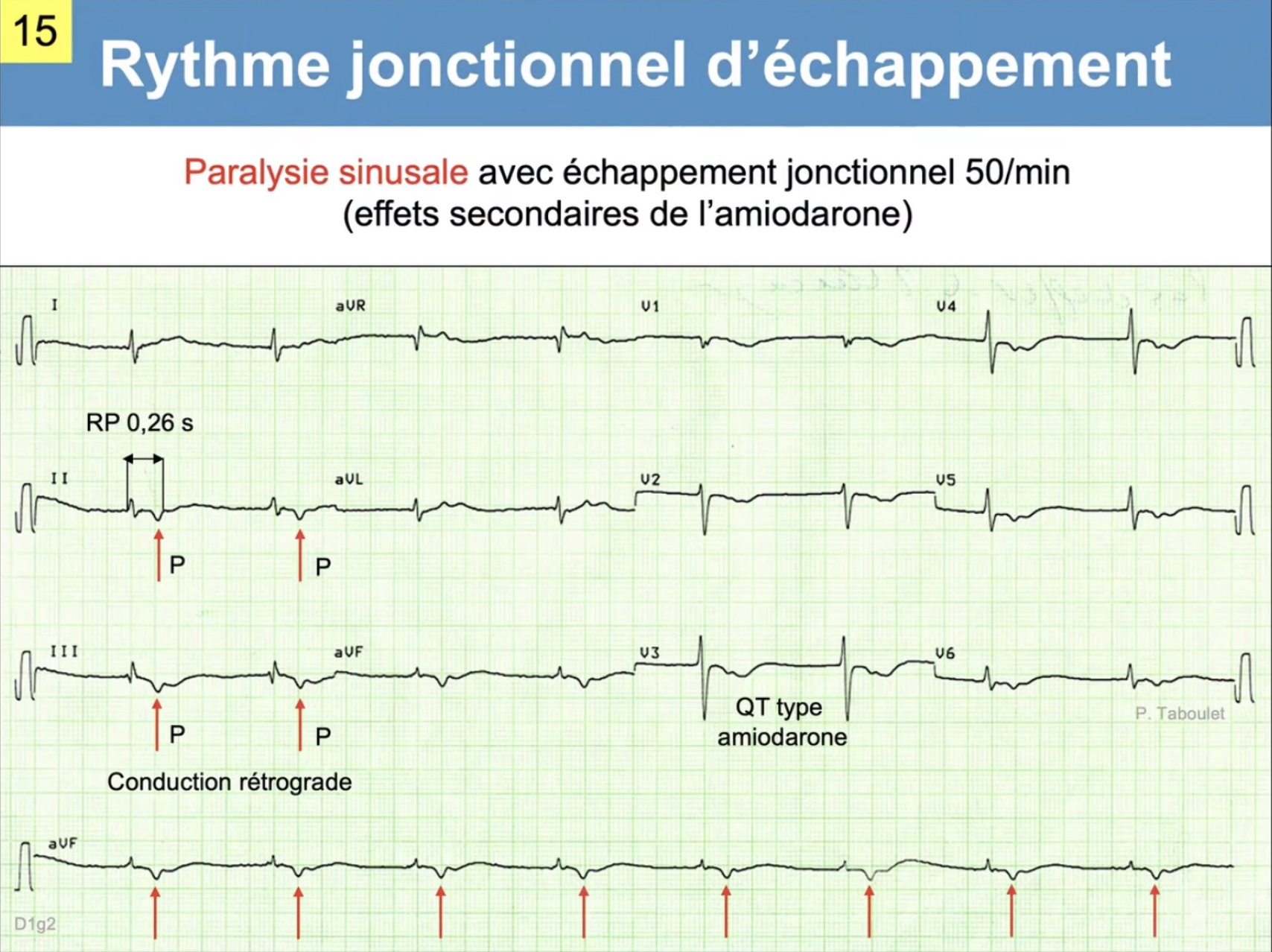 Rythme jonctionnel d'échappement — paralysie sinusale, P rétrograde, amiodarone