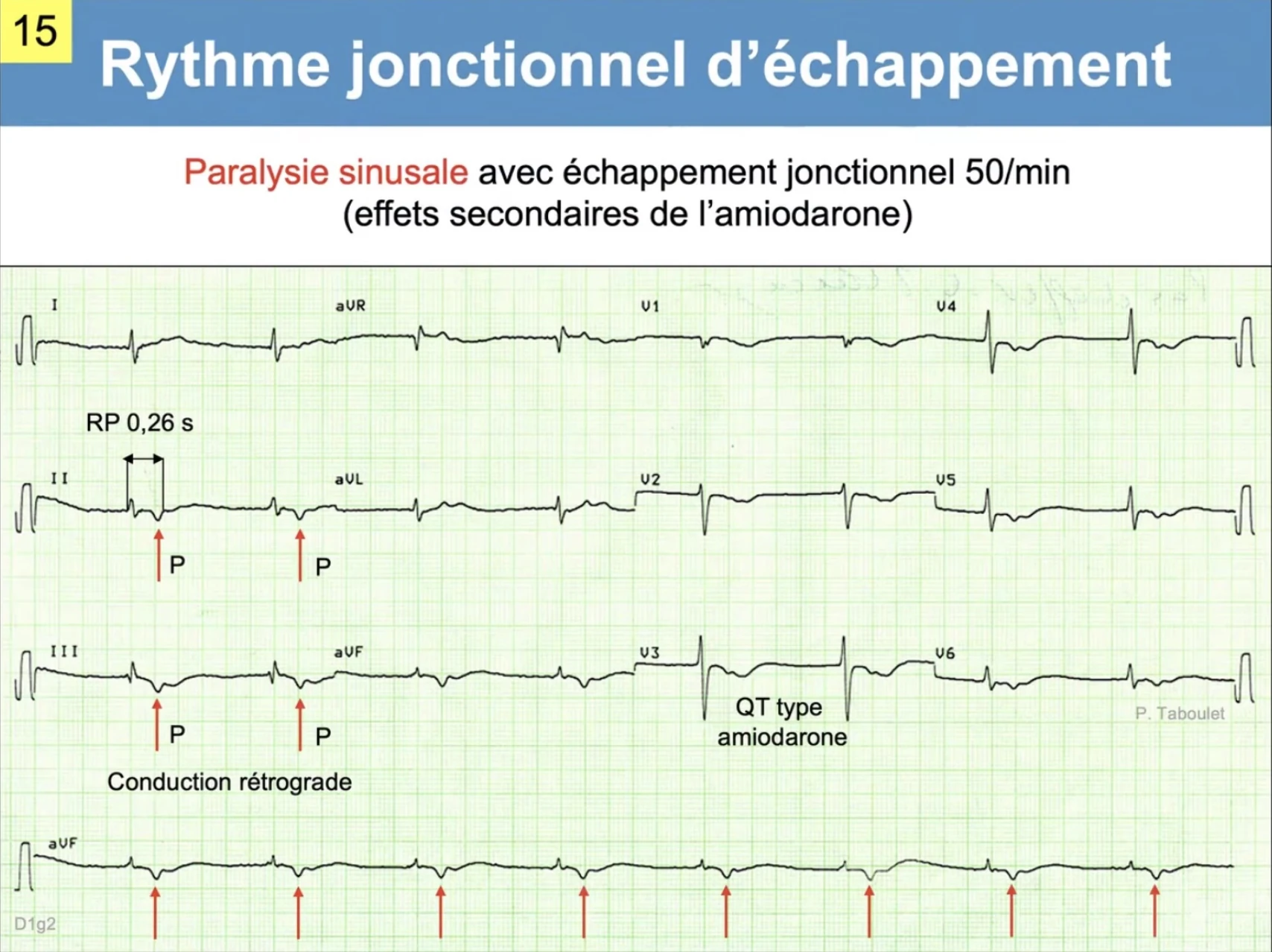 Rythme jonctionnel d'échappement — paralysie sinusale, P rétrograde, amiodarone