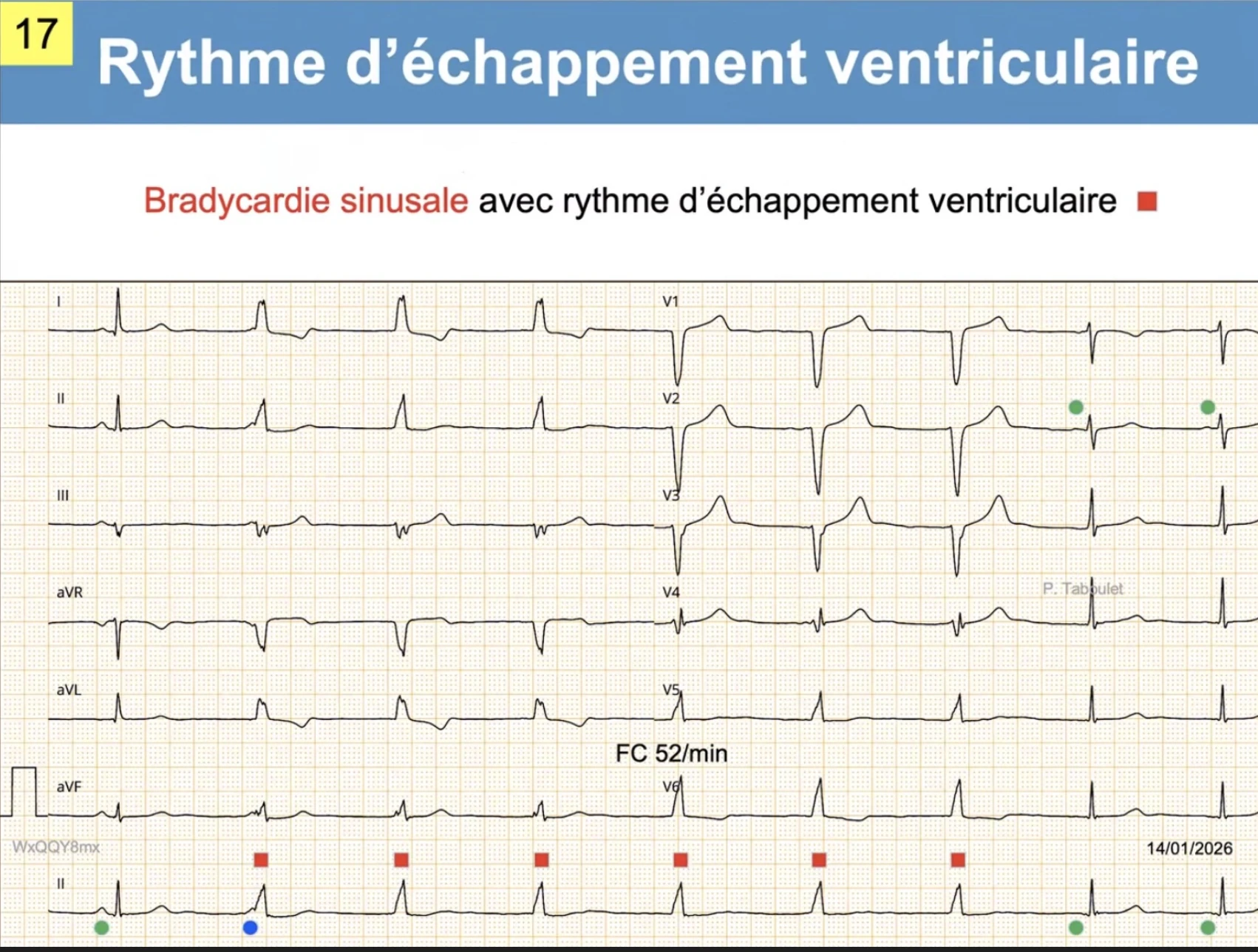 Échappement ventriculaire — QRS larges, dissociation AV