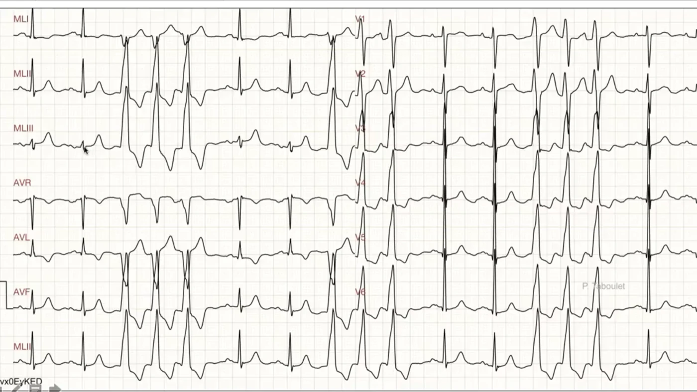 Ectopie ventriculaire — QRS larges, ondes R amples et larges, changement d'axe d'amplitude et de largeur dès le début du QRS